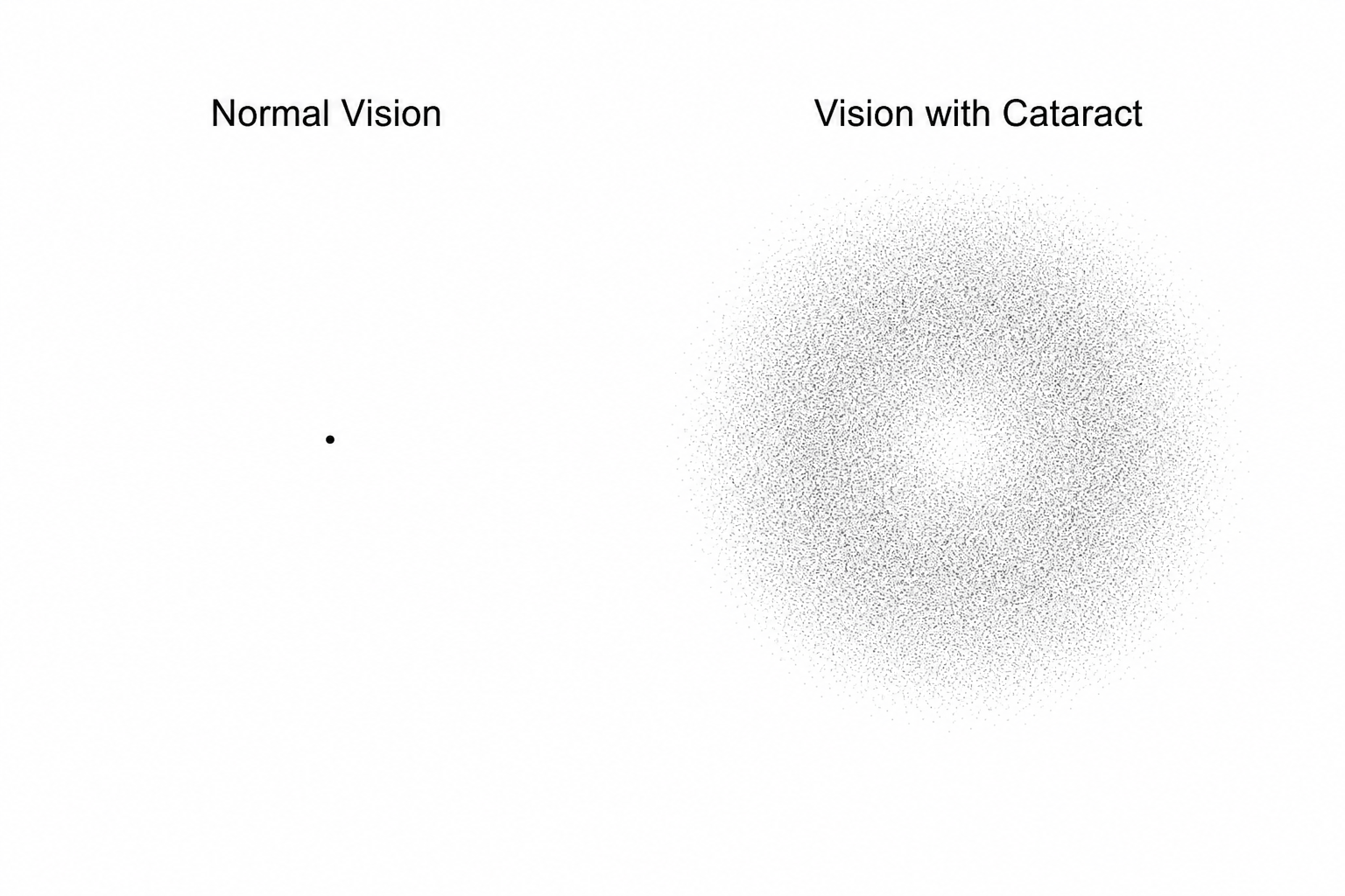 Visual perception of a point source of light under normal vision (sharp point) versus vision with a cataract (highly scattered, diffuse halo).