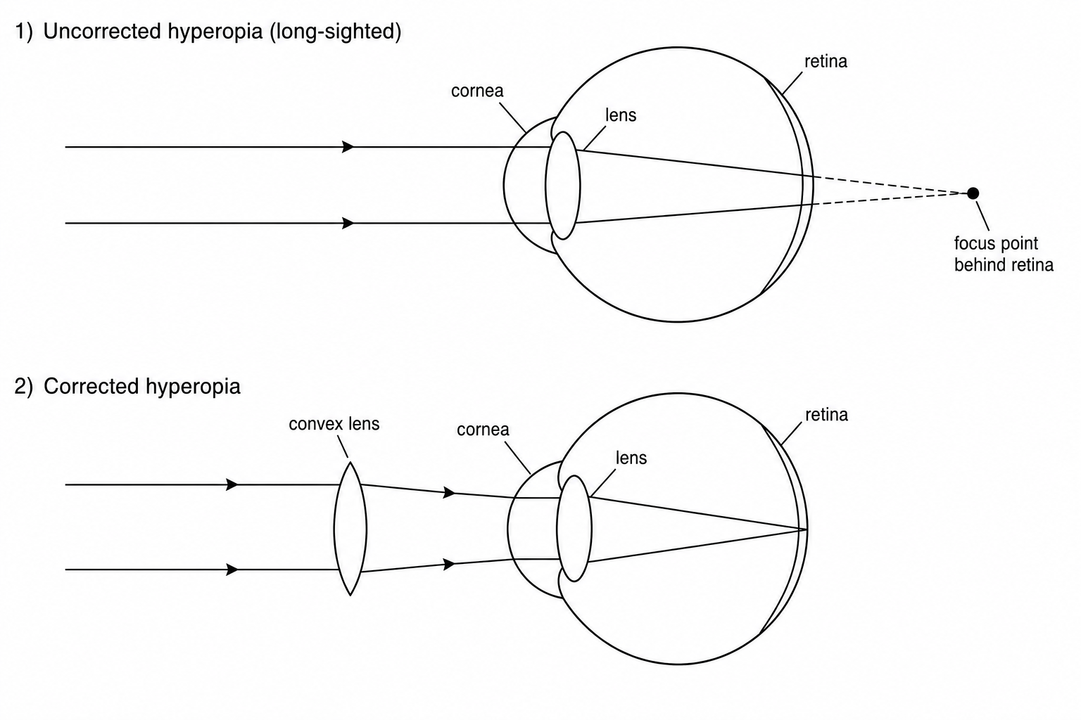 Diagram showing uncorrected hyperopia where light focuses behind the retina, and corrected hyperopia with a convex lens focusing light on the retina.