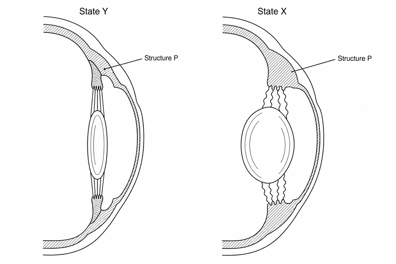 Anatomical diagram showing accommodation of the human eye from State Y to State X.