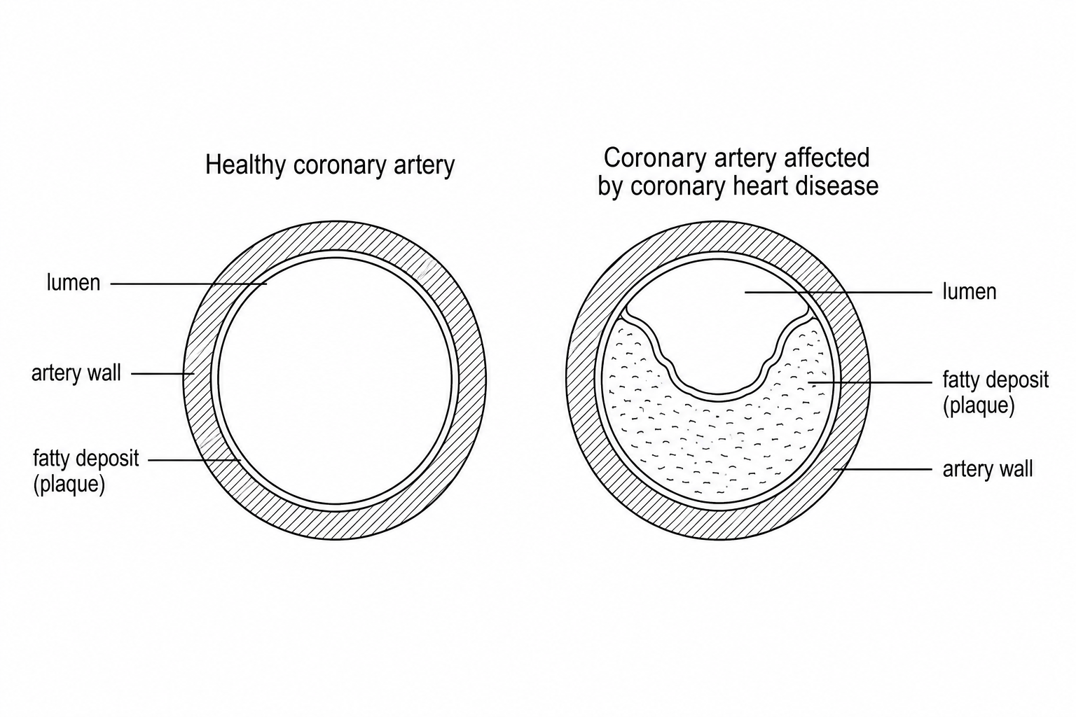 Cross-sections of a healthy and diseased coronary artery