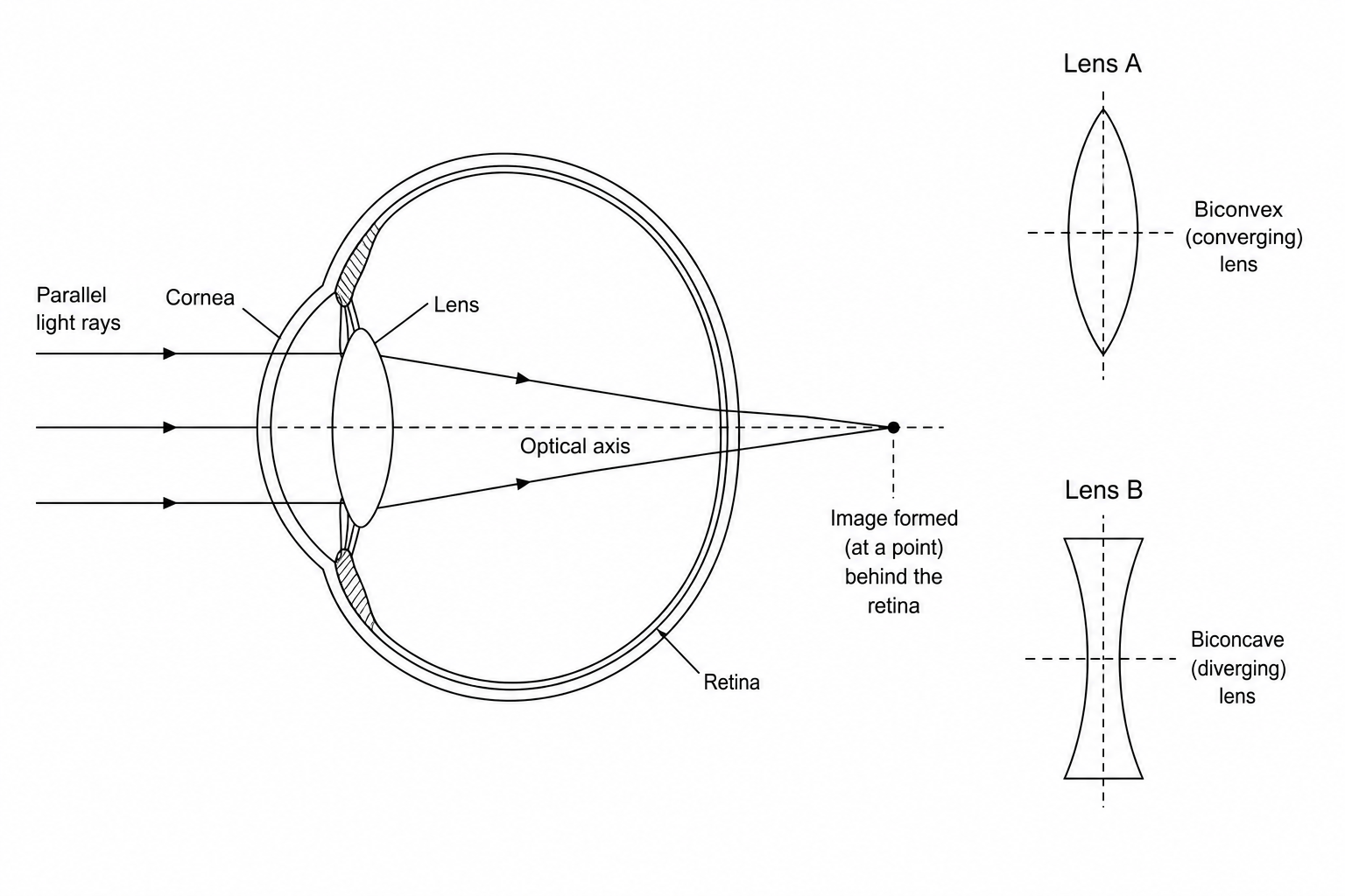 Diagram showing parallel light rays entering an eye and focusing at a point behind the retina. To the side are two lenses: Lens A, which is a convex (converging) lens, and Lens B, which is a concave (diverging) lens.泪