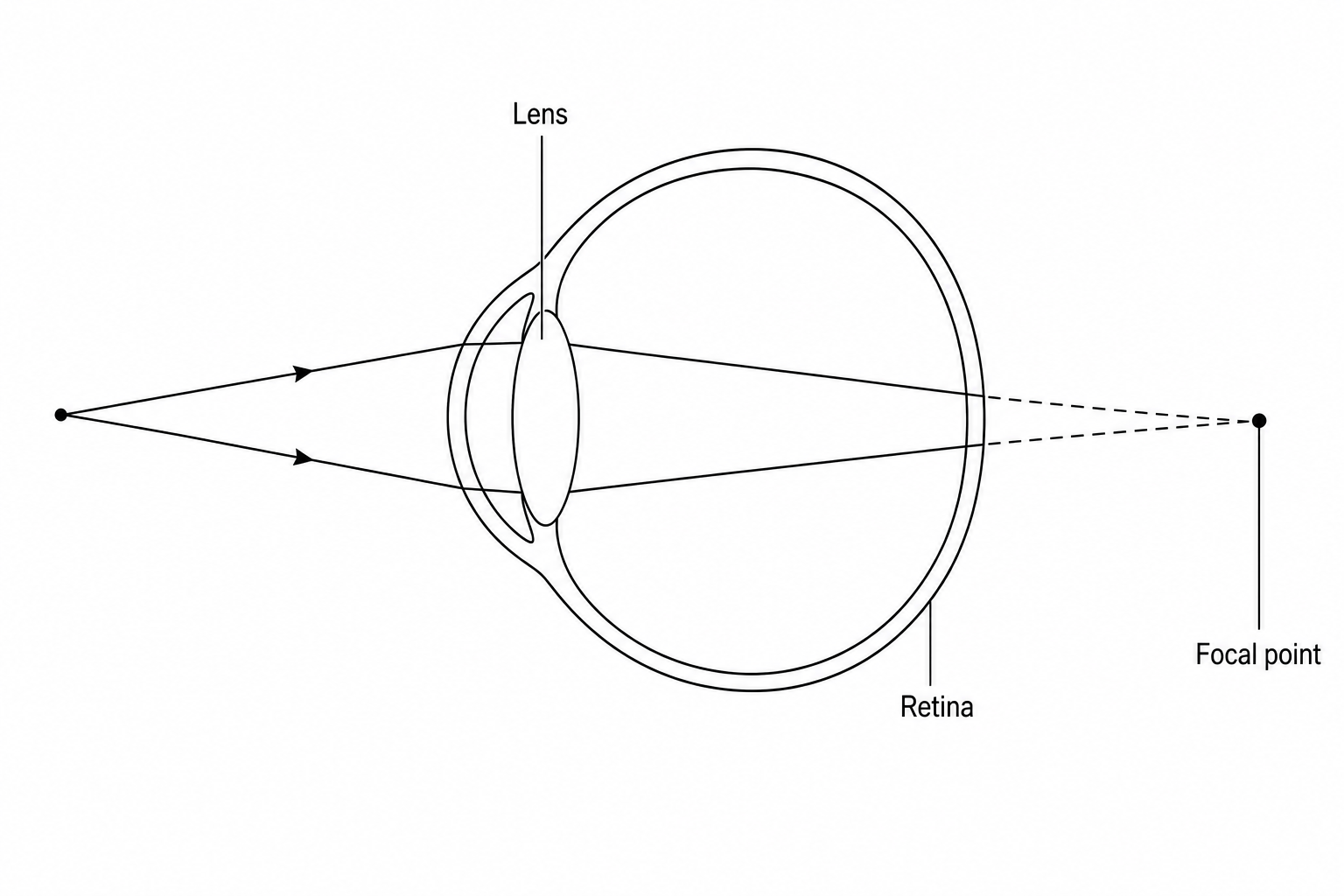 Figure 1: Cross-section of a human eye with a vision defect