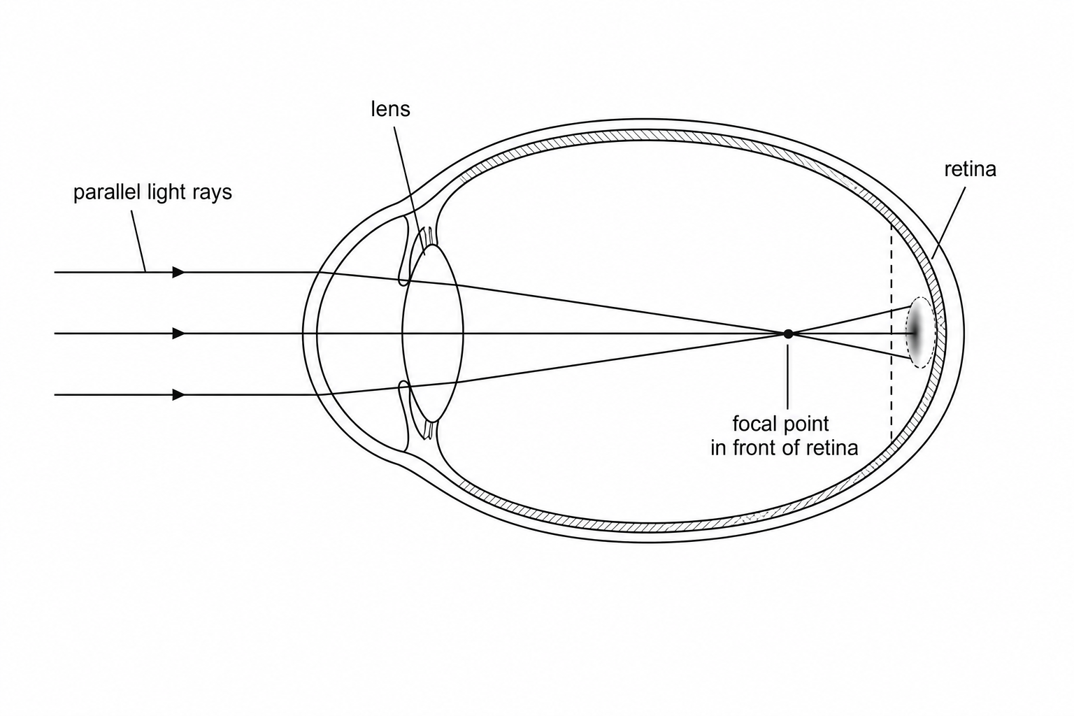 Figure 1: Path of light in a myopic eye