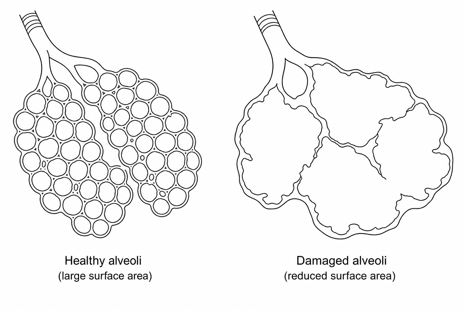 A diagram comparing lung tissue. The healthy tissue on the left shows numerous small, rounded alveoli forming a large surface area. The damaged tissue on the right shows broken-down alveolar walls, merging into much fewer, larger air cavities with a reduced surface area.