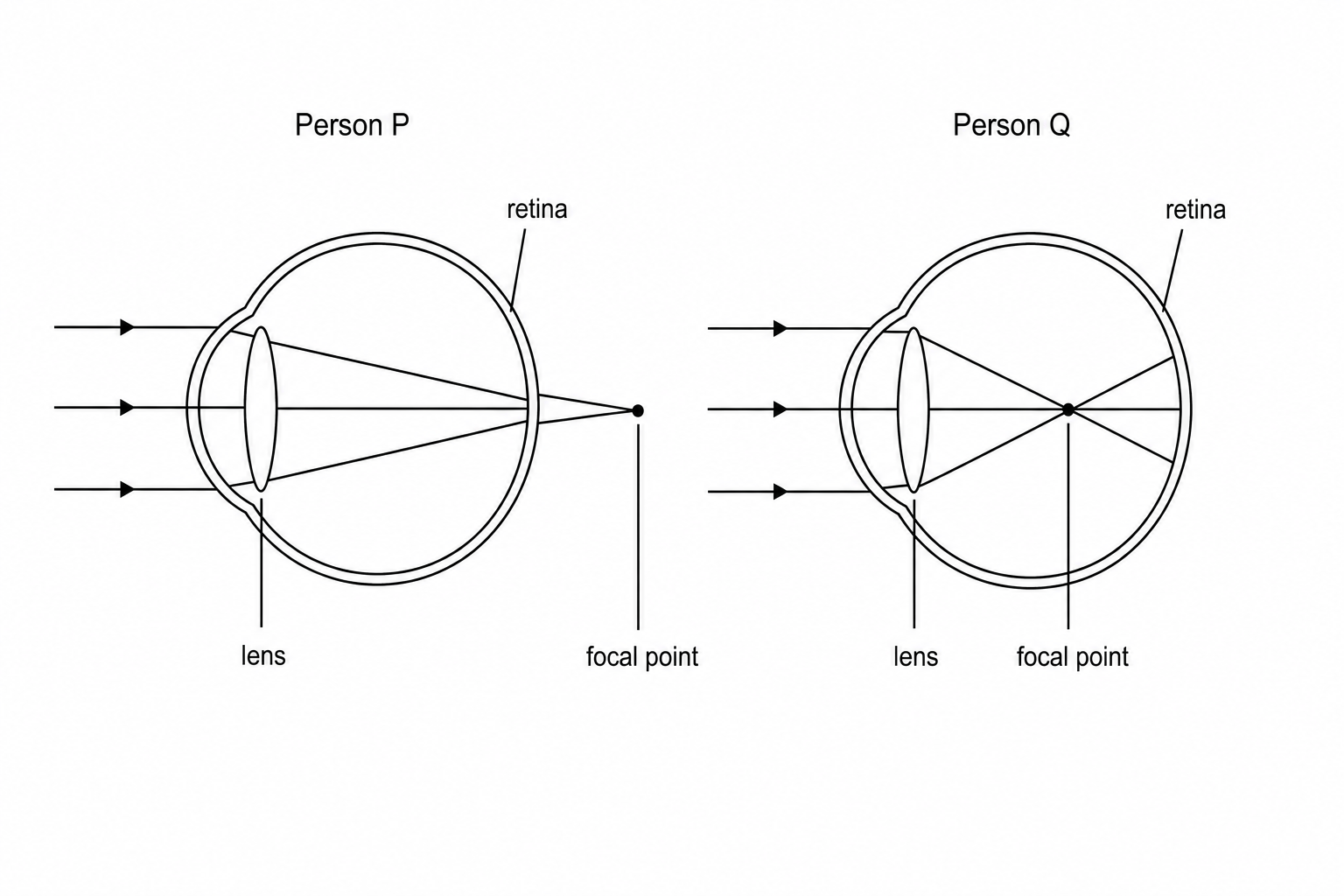 Two diagrams showing simplified horizontal cross-sections of human eyes. In the eye of Person P, two parallel incoming horizontal light rays pass through the lens and converge at a point behind the retina at the back of the eye. In the eye of Person Q, two parallel incoming horizontal light rays pass through the lens and converge at a point in the middle of the eyeball, well in front of the retina.