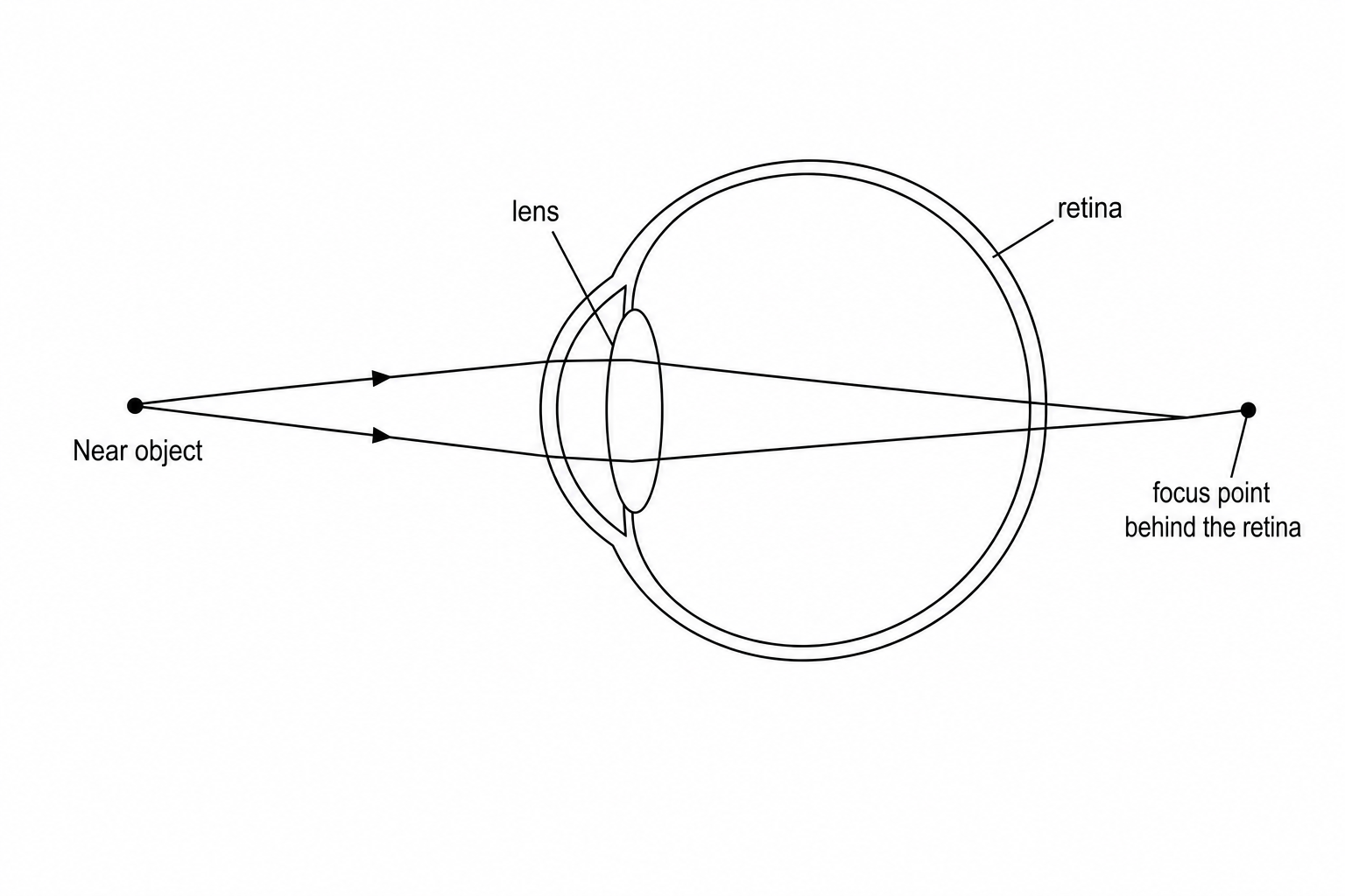 A simplified diagram of a long-sighted eye showing rays of light from a near object passing through the cornea and lens. The light rays converge and focus at a point behind the retina.