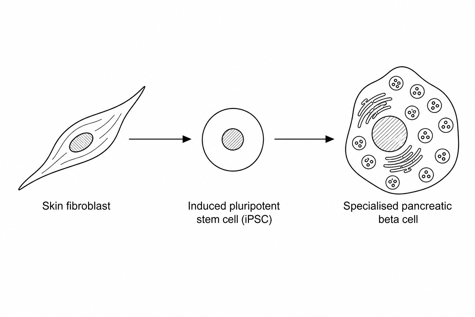 A scientific flow diagram showing the laboratory process of stem cell differentiation, from a skin fibroblast to an induced pluripotent stem cell (iPSC), and finally to a specialised pancreatic beta cell.