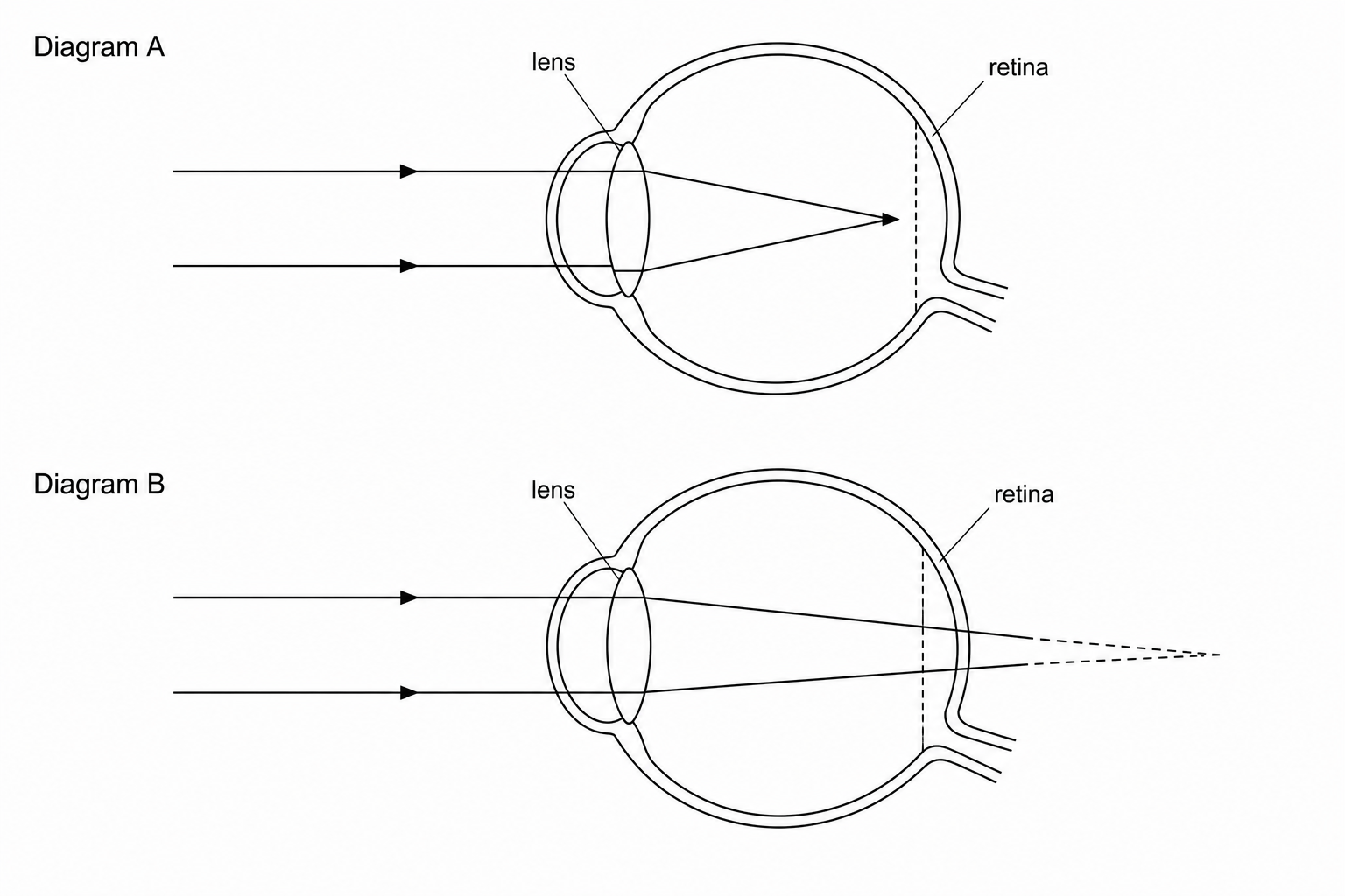 Figure 1: Two diagrams illustrating vision defects. In Diagram A, incoming parallel light rays pass through the lens and converge to a focal point in front of the retina. In Diagram B, incoming parallel light rays pass through the lens and converge to a point behind the retina.