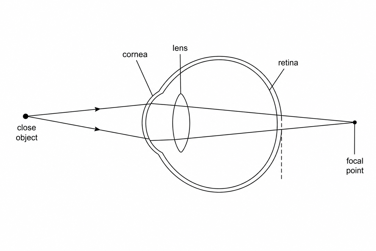 Figure 1: Diagram of an eye showing light rays originating from a close object. The light rays pass through the cornea and lens, and converge at a focal point located behind the retina instead of directly on it.