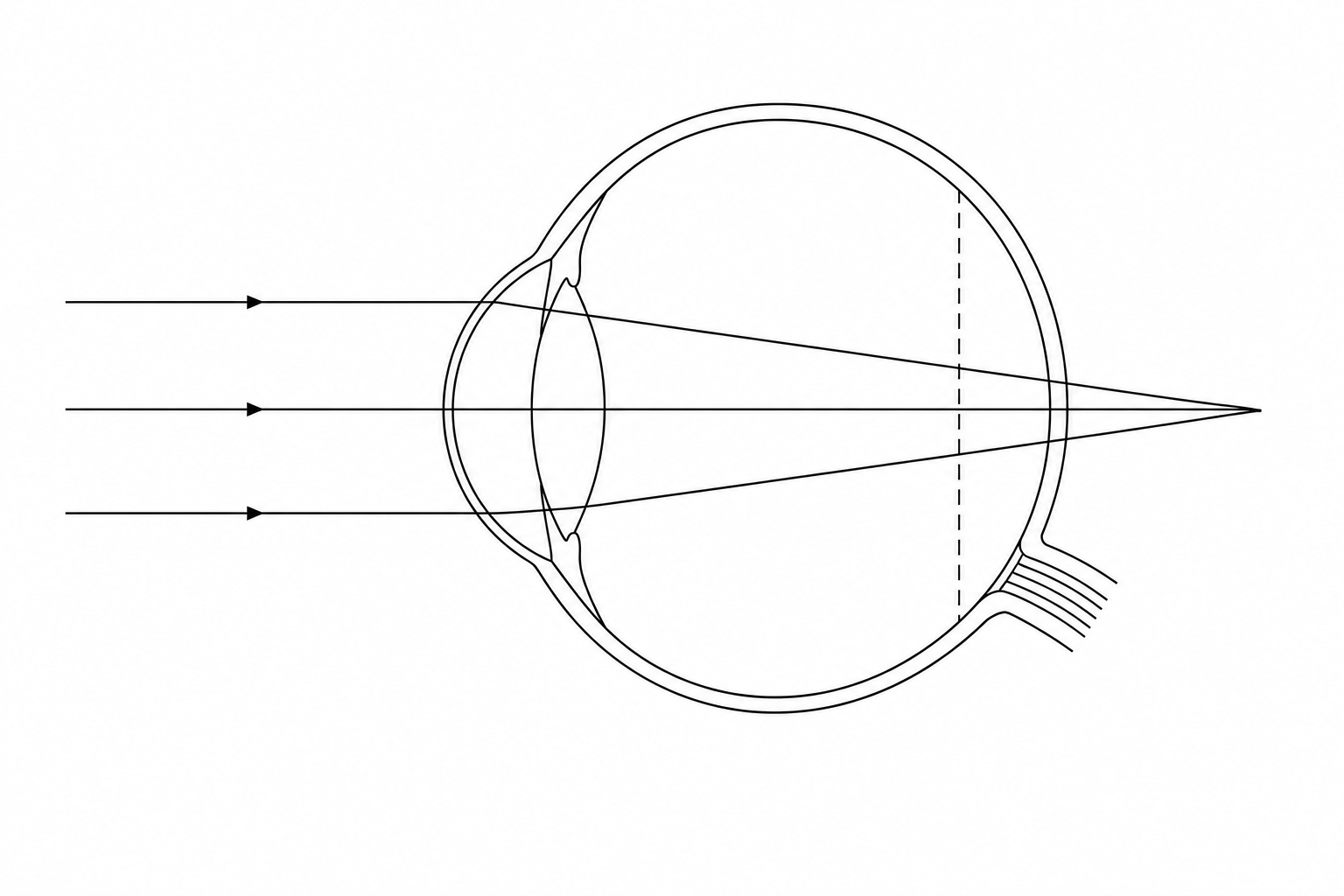Hyperopic eye