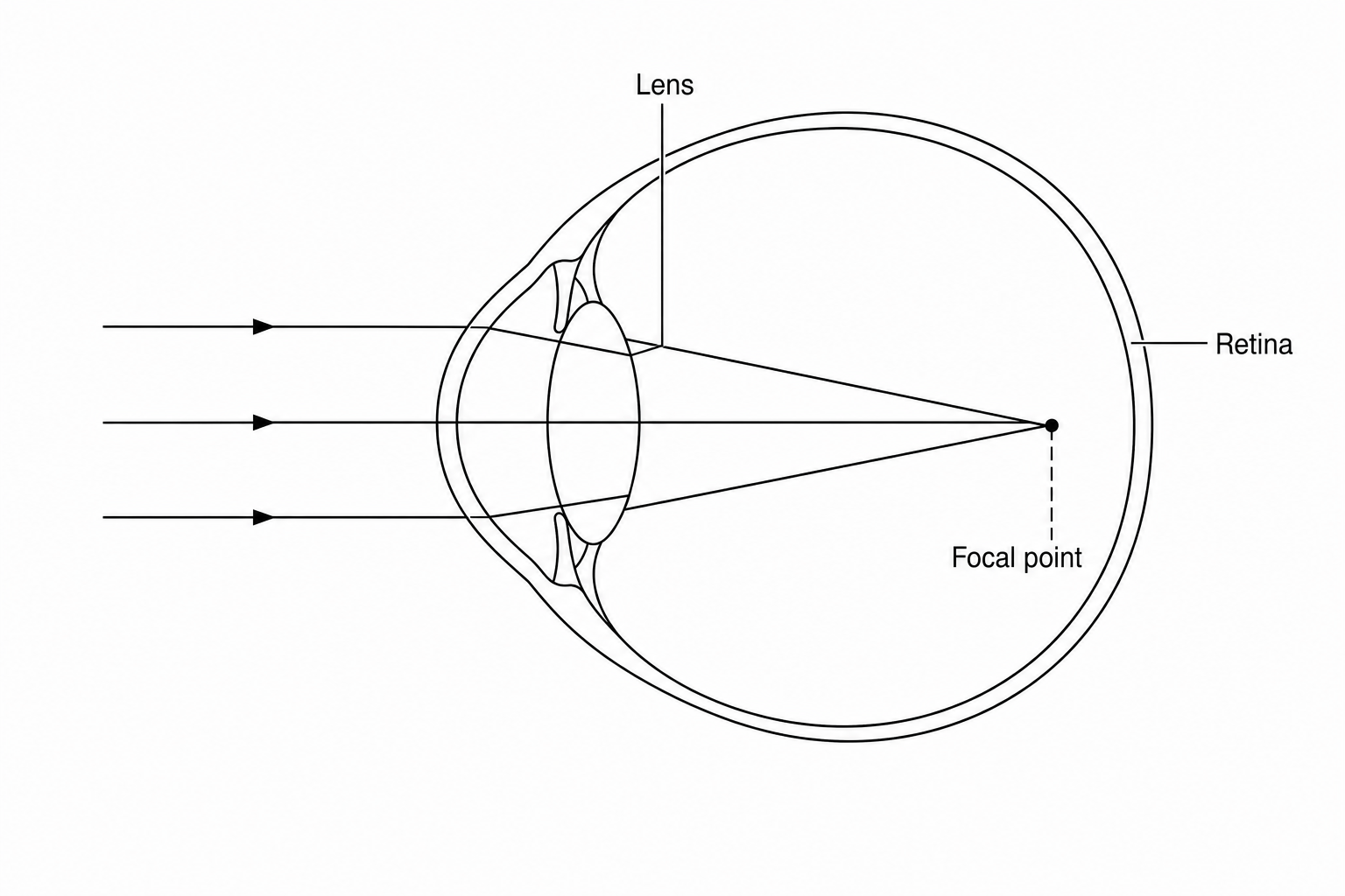 A simplified cross-section diagram of an eye. Parallel light rays enter from the left, pass through the lens, and converge at a focal point inside the eye, in front of the retina.