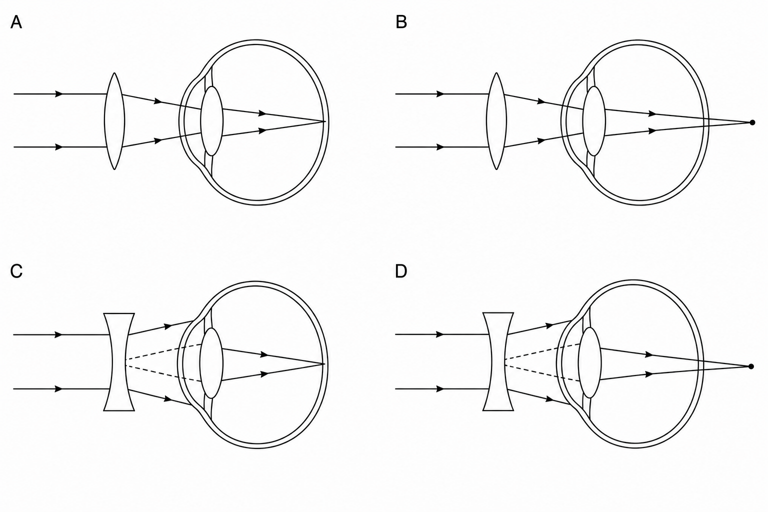 Diagrams showing correction of long-sightedness