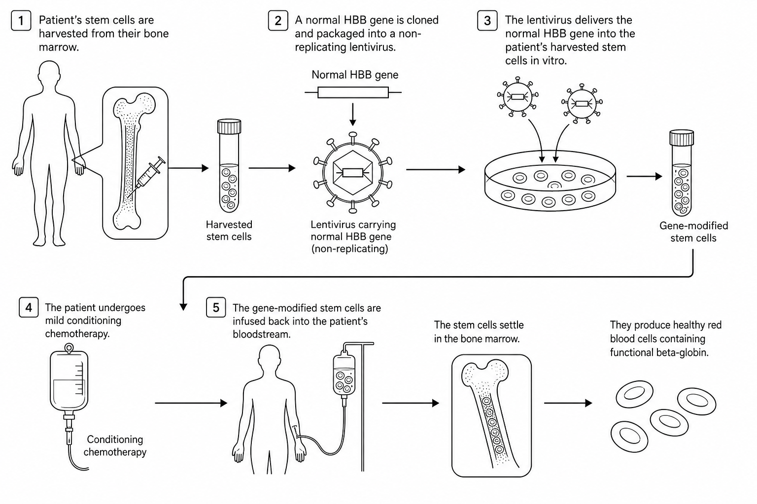 A diagram showing the five steps of ex vivo gene therapy for beta-thalassemia, where a patient's own stem cells are harvested, modified in vitro with a lentiviral vector carrying the functional HBB gene, and infused back after mild conditioning chemotherapy.