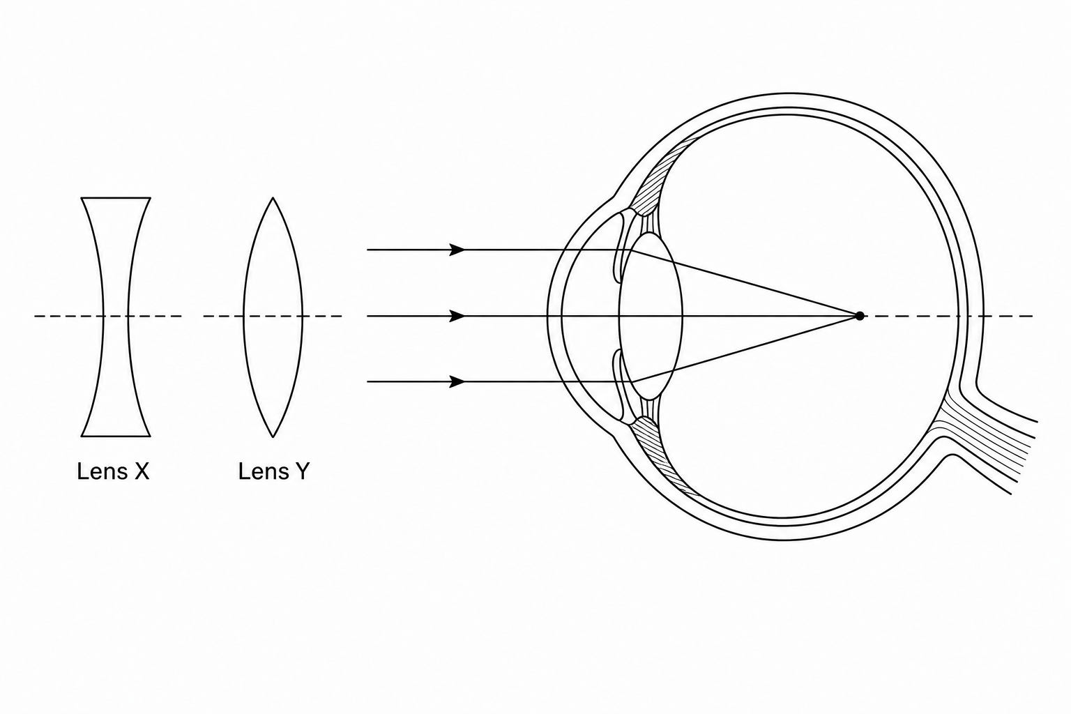 Figure 1: Schematic showing a vision defect and two correcting lenses.
