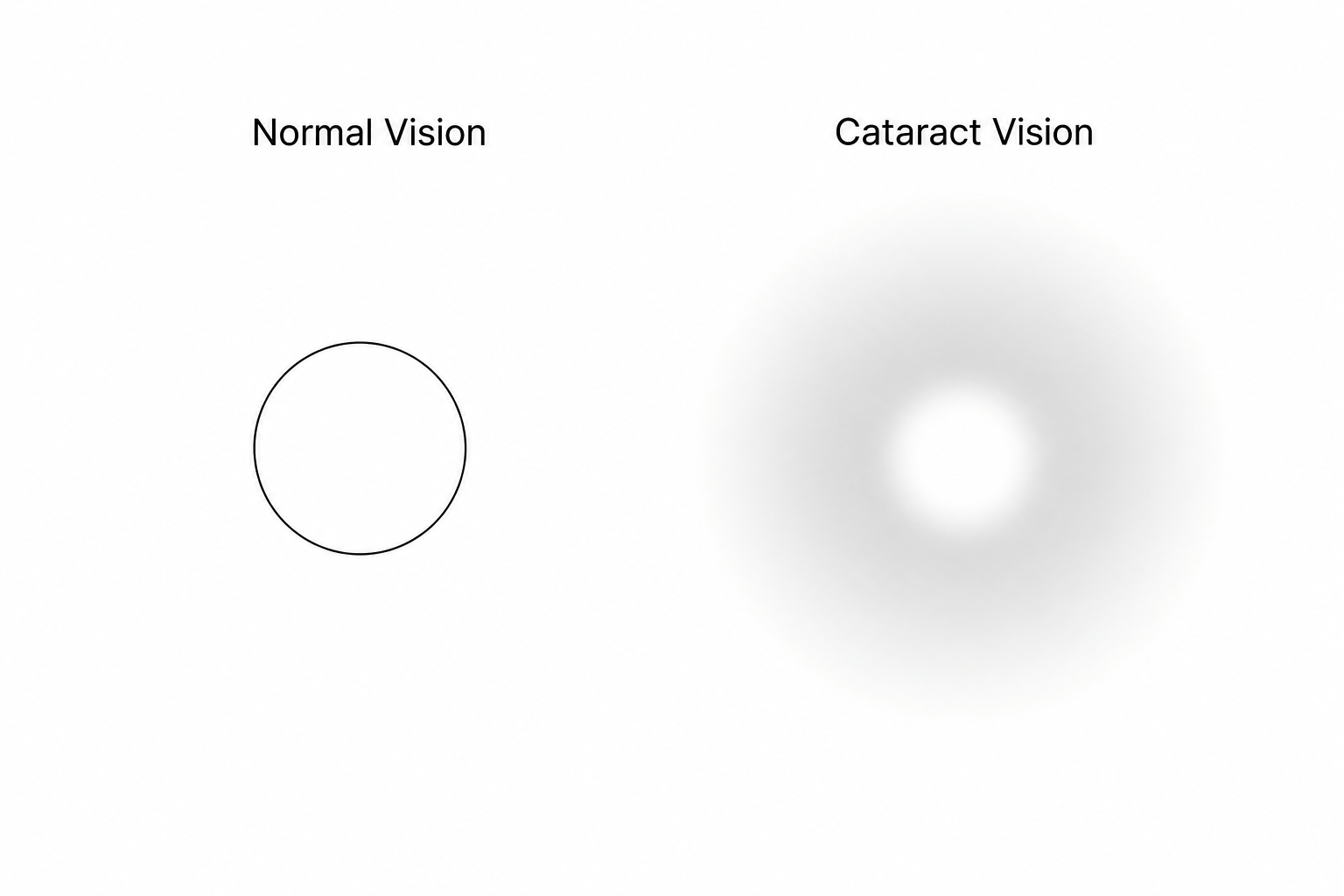 A comparison of vision. On the left, 'Normal Vision' shows a sharp, well-defined green circular traffic light against a dark background. On the right, 'Cataract Vision' shows a very blurry, dim, and diffused green light with a wide, fuzzy halo surrounding it.