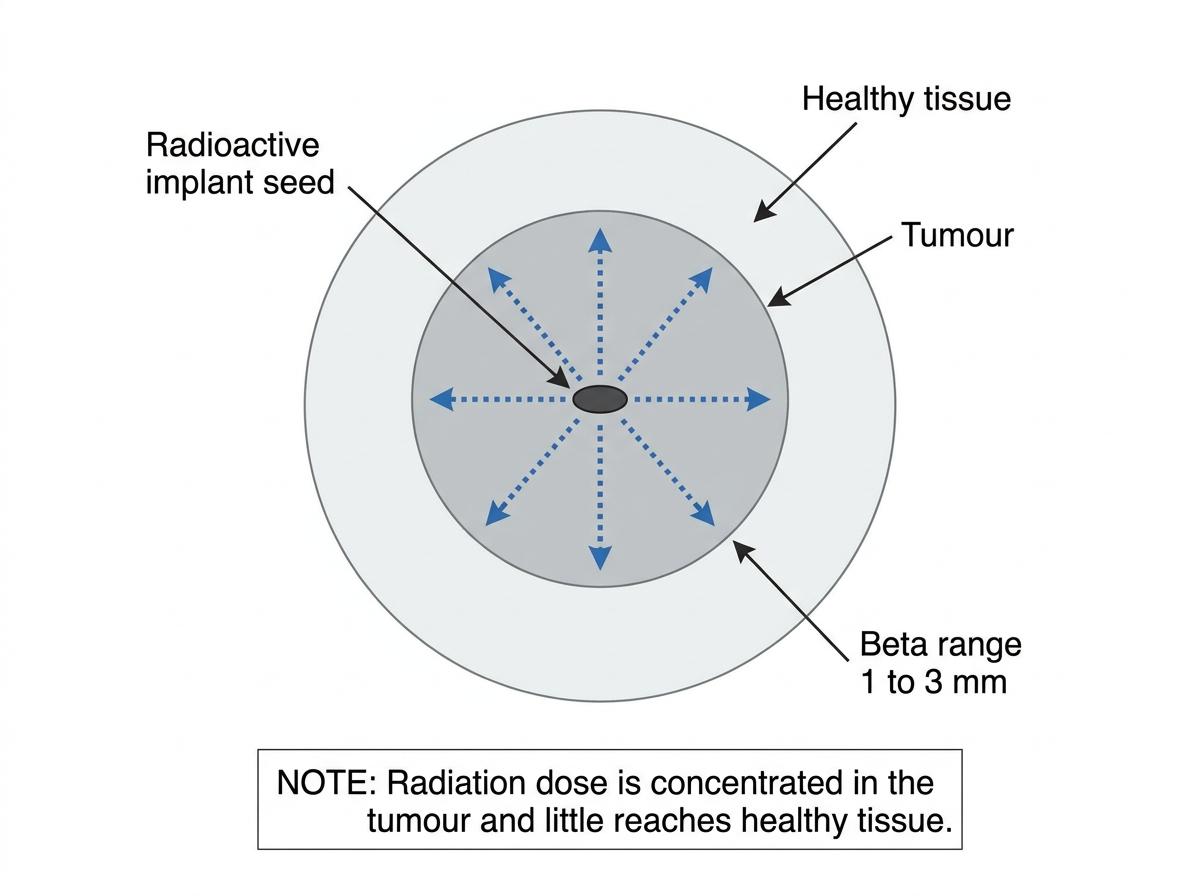 Cross-sectional diagram of a tumour with a sealed implant at the centre emitting short-range beta particles that stop within the tumour, leaving surrounding healthy tissue largely unaffected