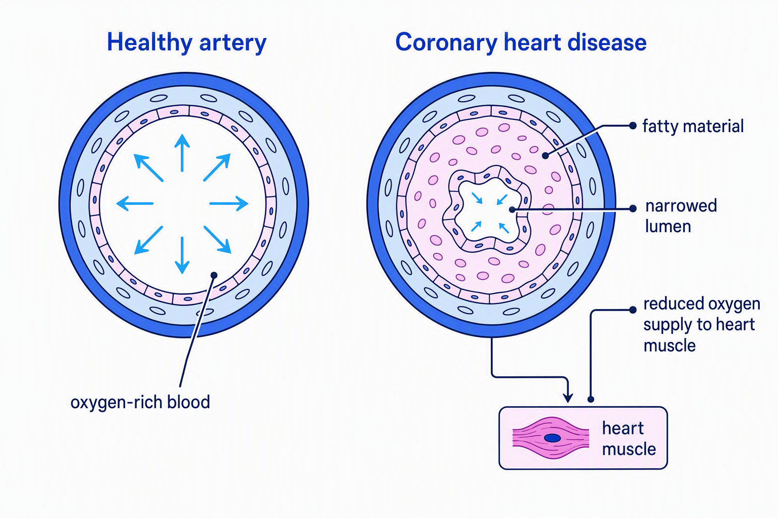 Cross-sections comparing a healthy coronary artery with a coronary artery narrowed by fatty material, showing reduced blood flow and oxygen supply