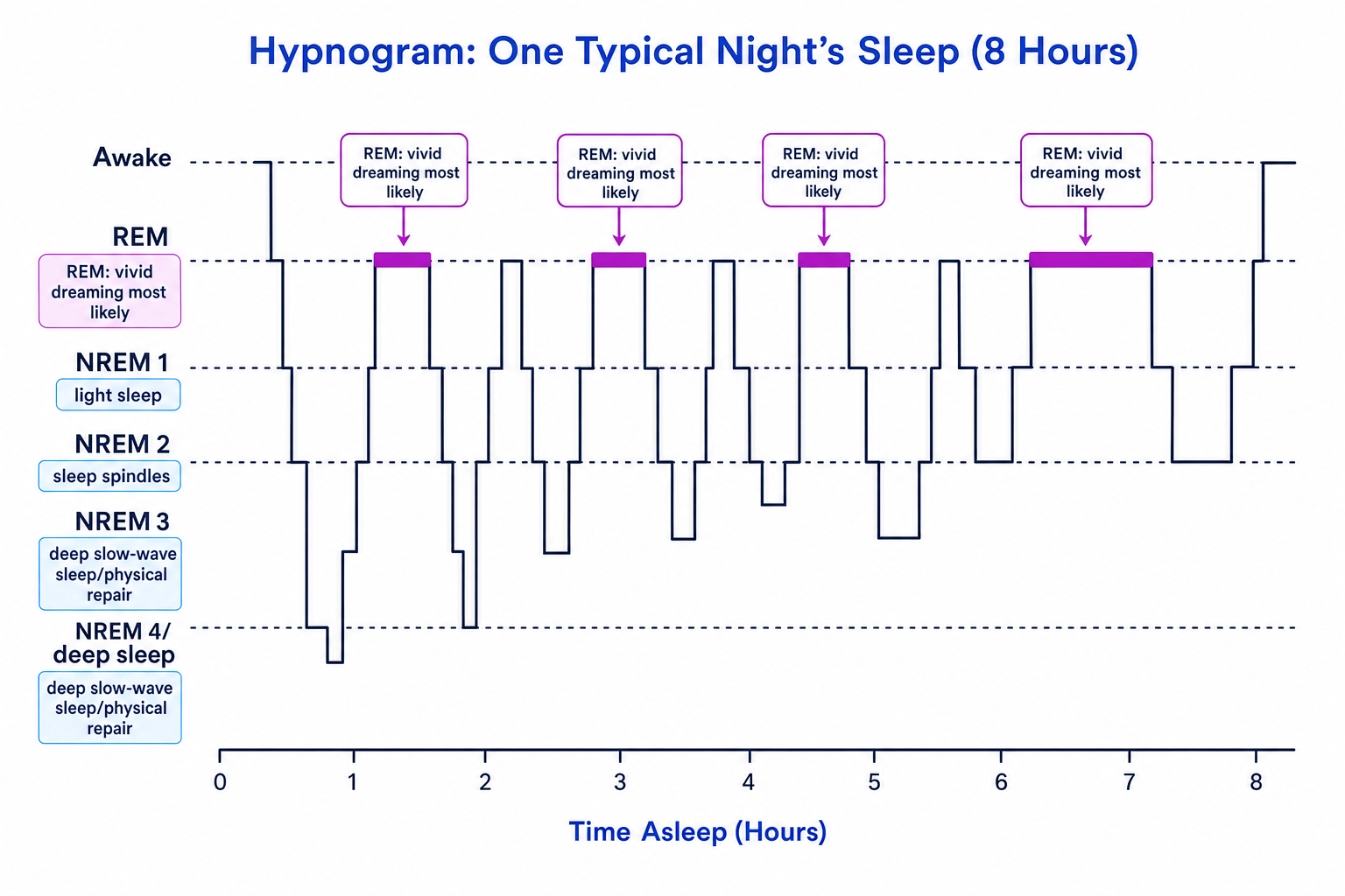 Hypnogram showing sleep cycles across one typical night, with NREM stages, REM periods and vivid dreaming marked