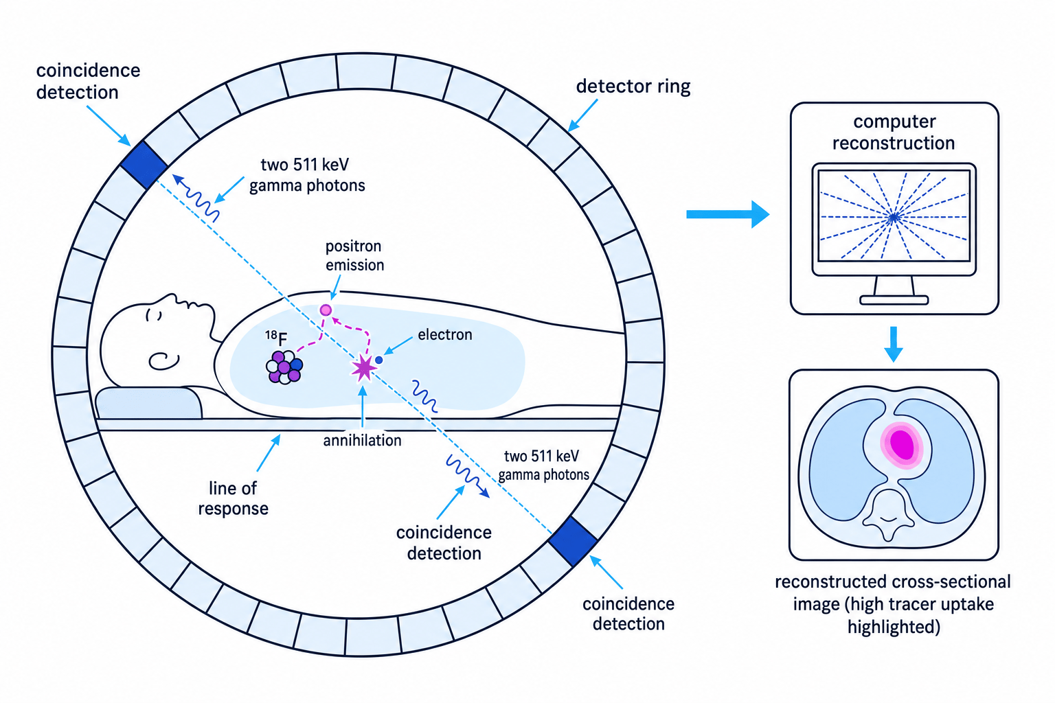 Schematic of PET scanning showing positron emission, annihilation, two opposite 511 keV gamma photons, coincidence detection and image reconstruction