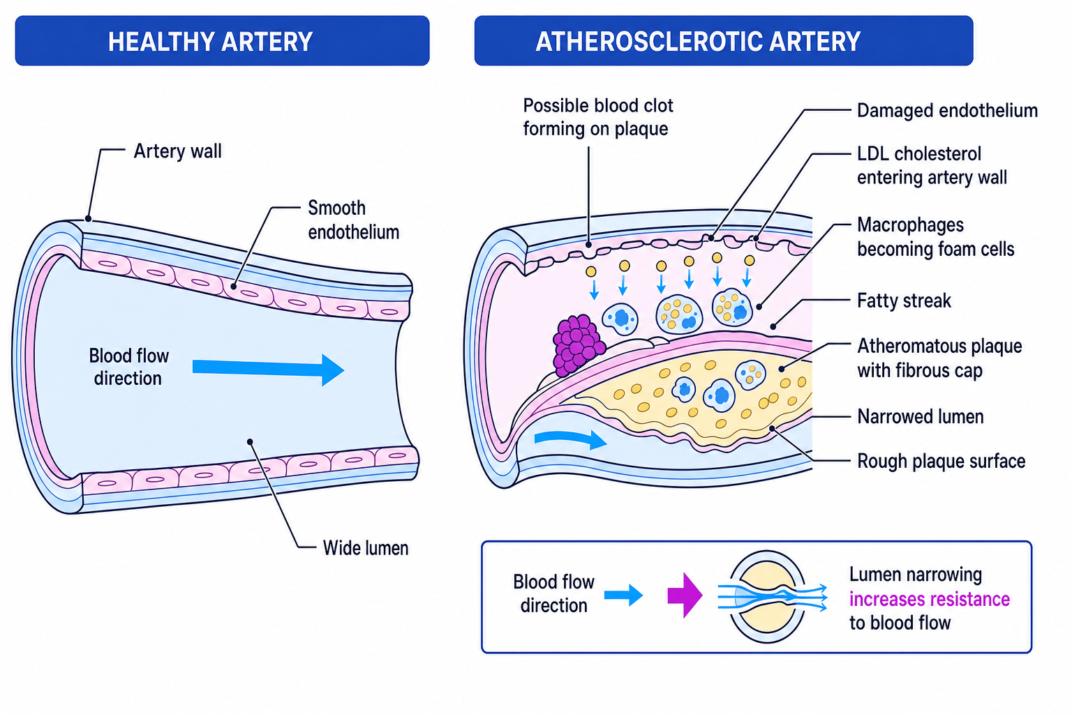 Labelled comparison of a healthy artery and an atherosclerotic artery showing LDL entry, foam cells, plaque formation and lumen narrowing