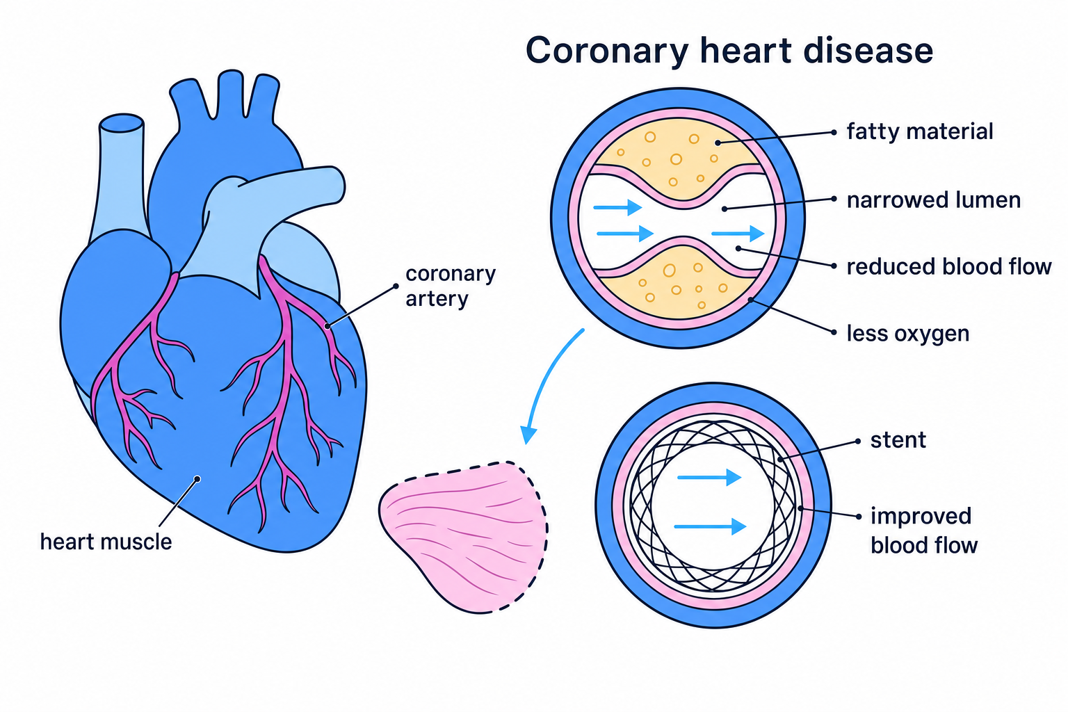 Labelled schematic of coronary heart disease showing fatty material narrowing a coronary artery and a stent improving blood flow