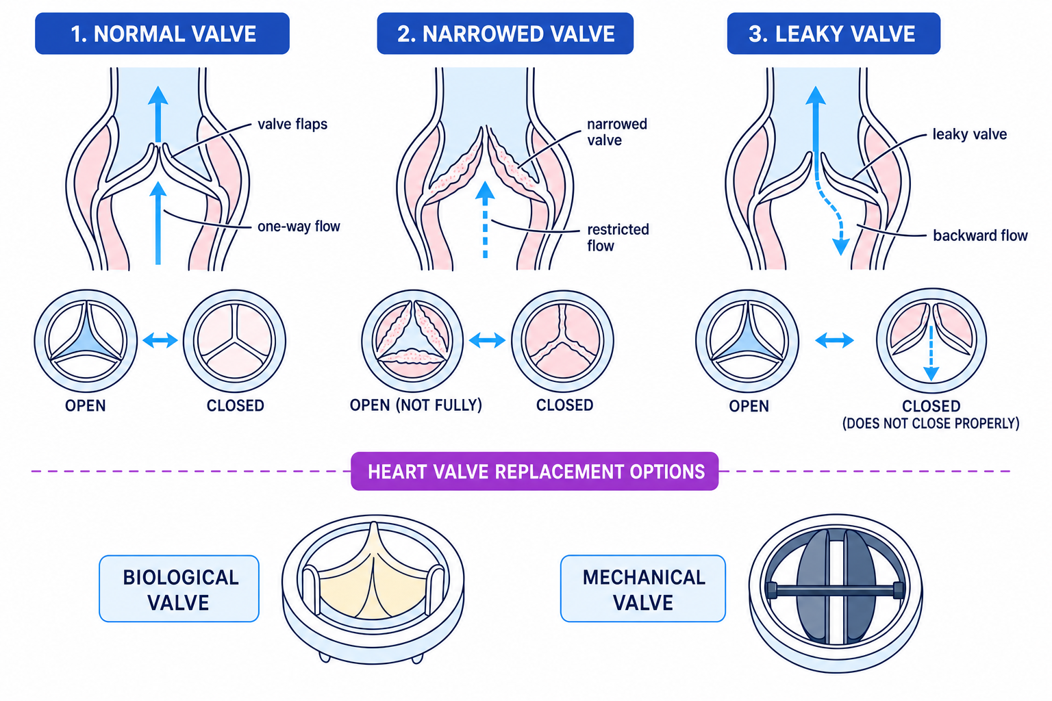 Diagram comparing normal, narrowed and leaky heart valves, plus biological and mechanical replacement valves