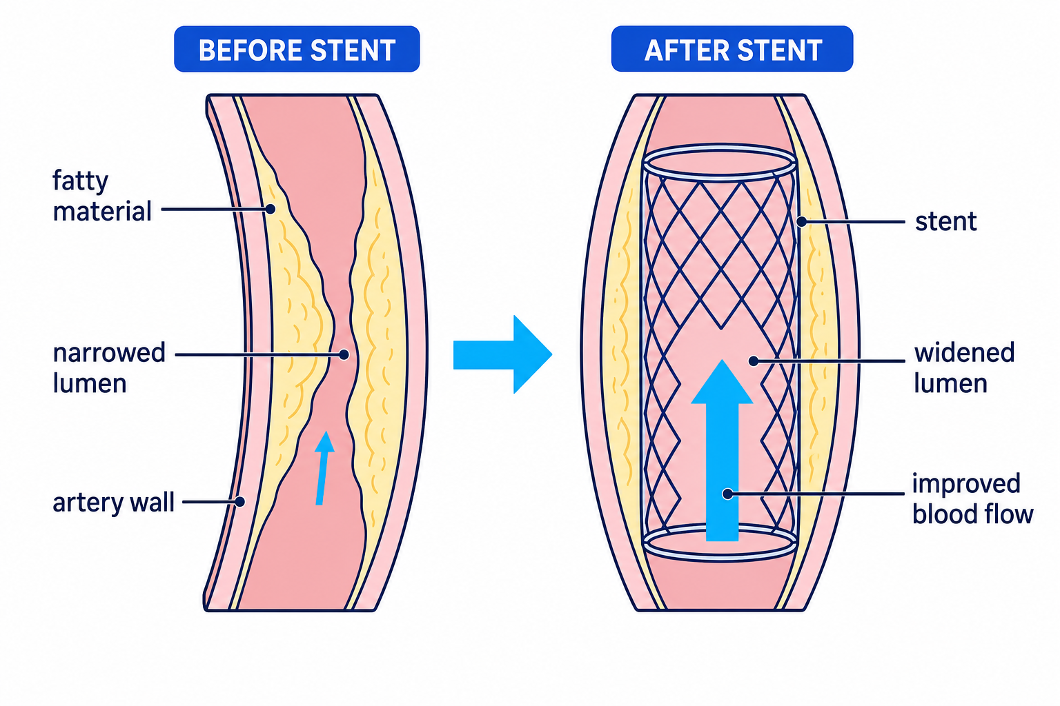 A stent holds a narrowed coronary artery open so more blood can flow through the lumen.