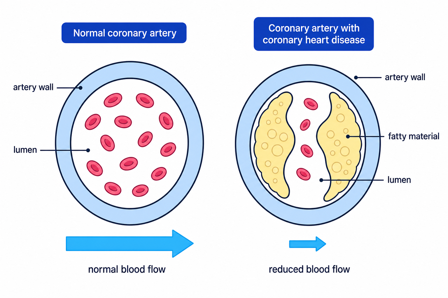 A cross-section of a coronary artery showing how fatty deposits narrow the lumen and reduce blood flow.