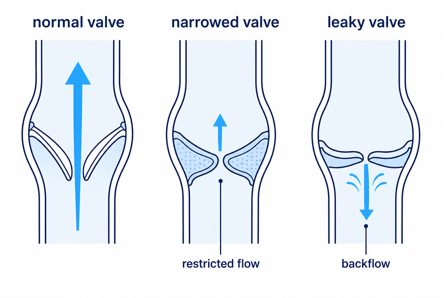 Normal, narrowed and leaky valves compared to show the two main ways heart valves become faulty.