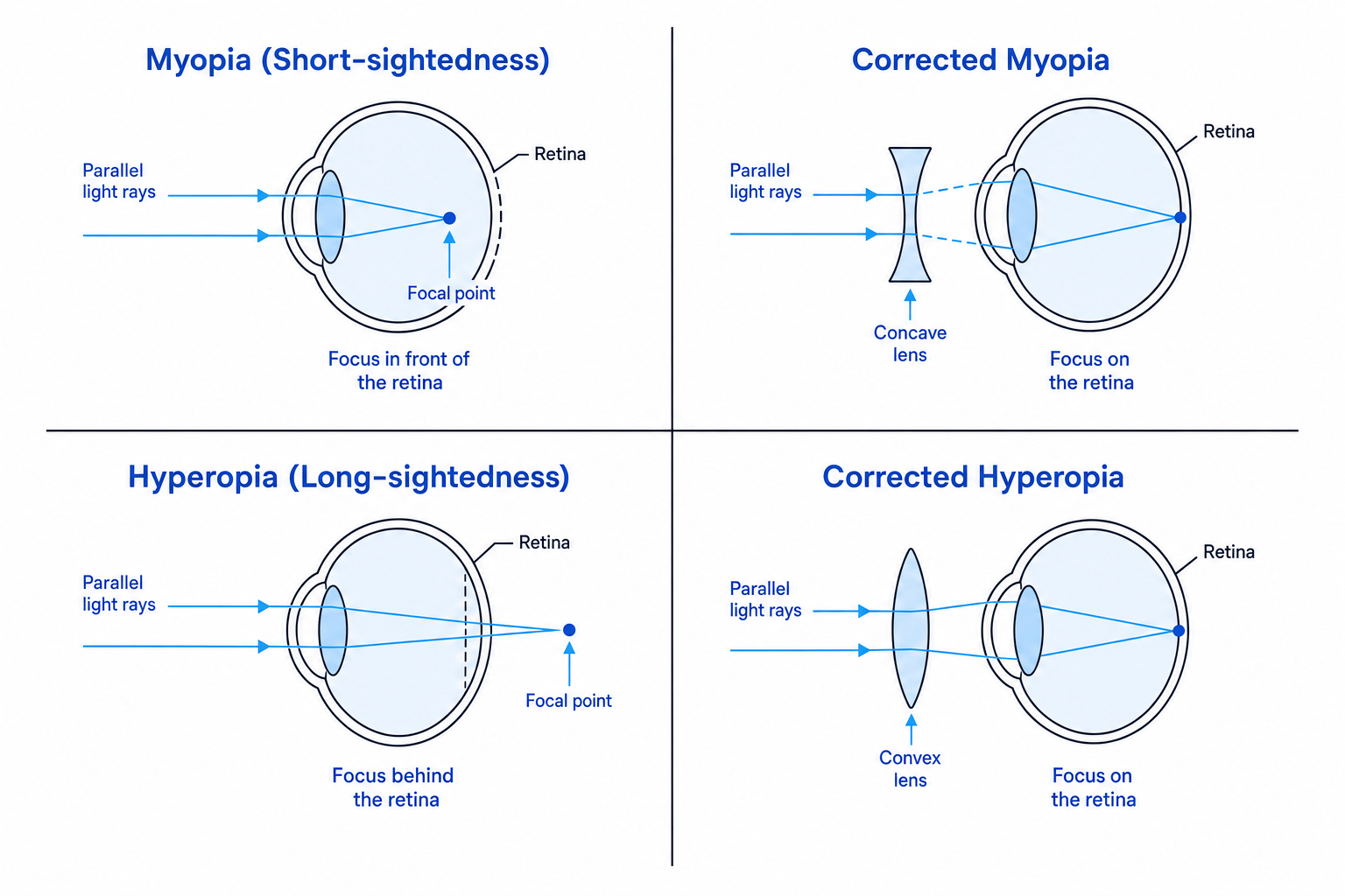 Short-sightedness vs. long-sightedness and their corrections