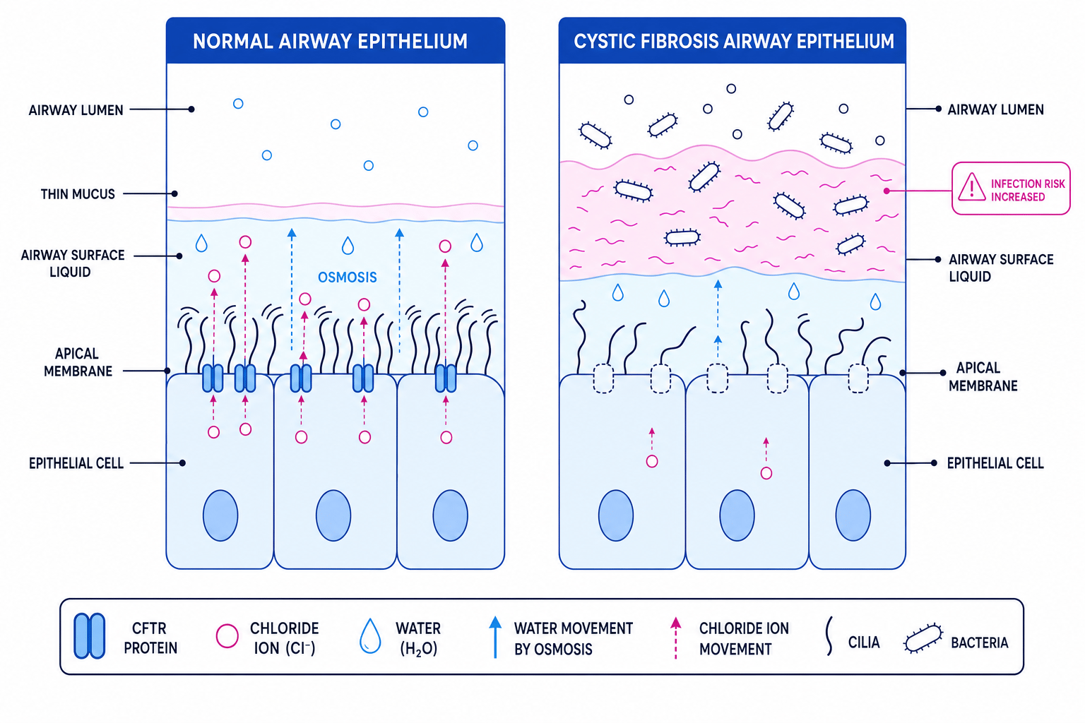 Diagram comparing normal and cystic fibrosis airway epithelium, showing CFTR chloride channels, water movement by osmosis, mucus thickness, cilia, and infection risk