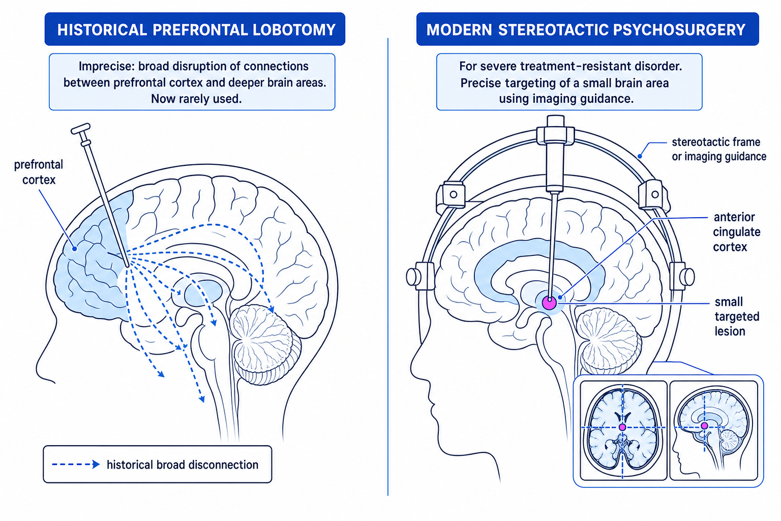 Historical lobotomy compared with modern stereotactic psychosurgery