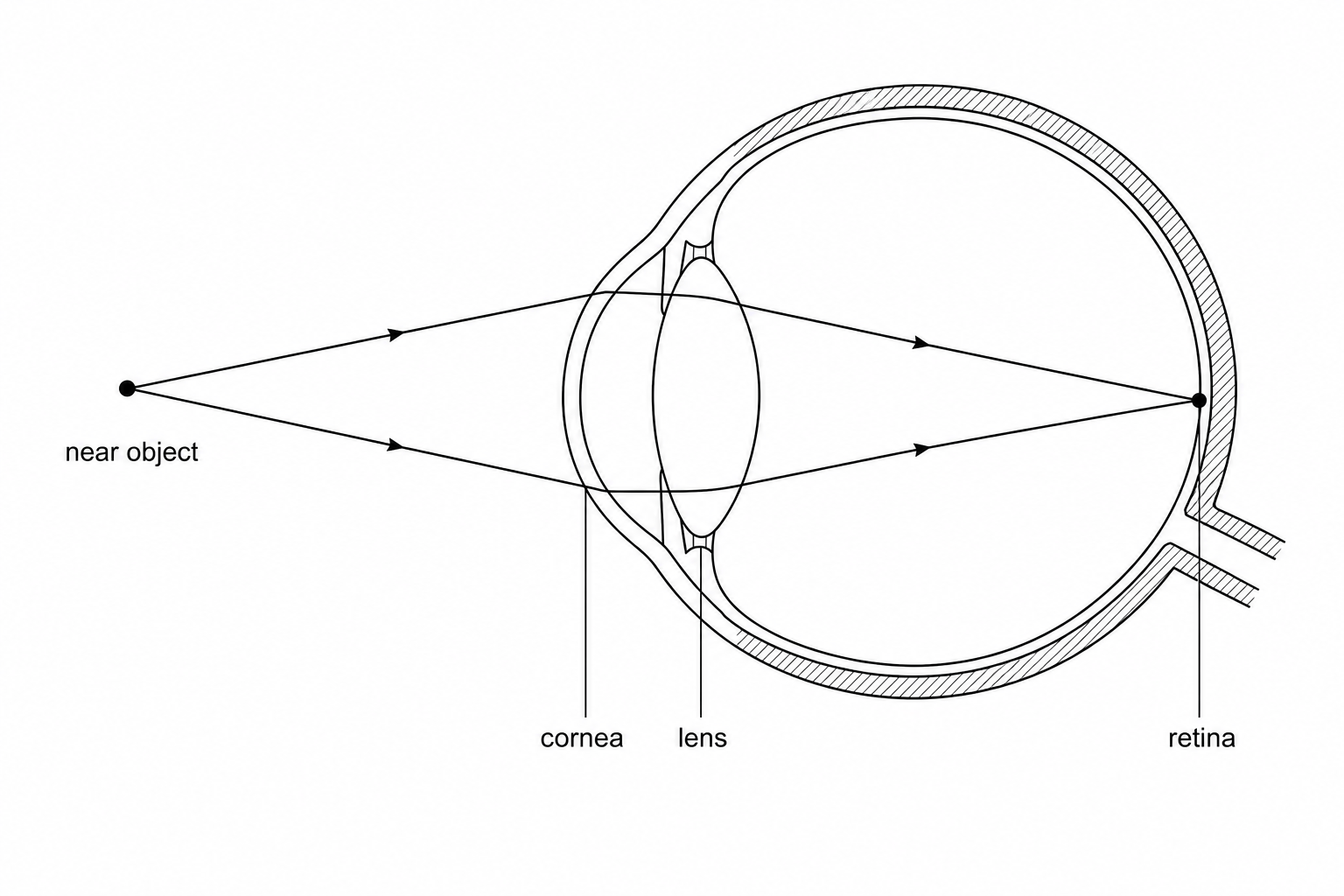 A cross-section diagram of a human eye focusing on a near object. Light rays diverge from a point on a near object on the left, pass through the cornea and a relatively thick, rounded lens inside the eye, and converge to meet at a single point exactly on the retina at the back of the eye.