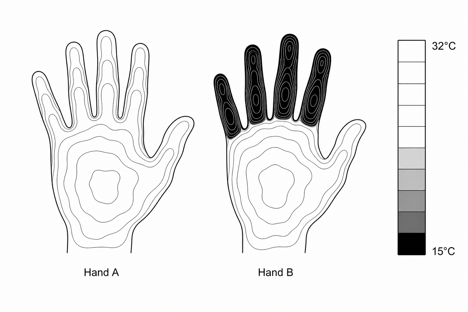 Thermogram showing Hand A and Hand B after exposure to cold water