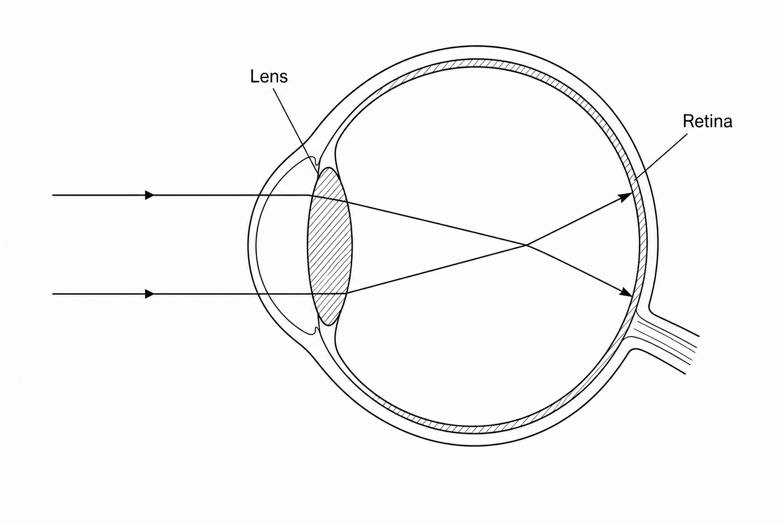 An eye defect showing light rays focusing in front of the retina