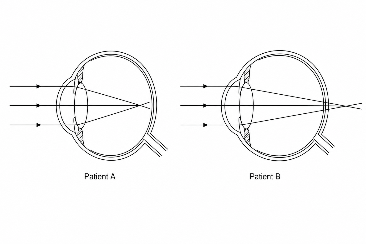Ray diagrams showing vision defects for Patient A and Patient B