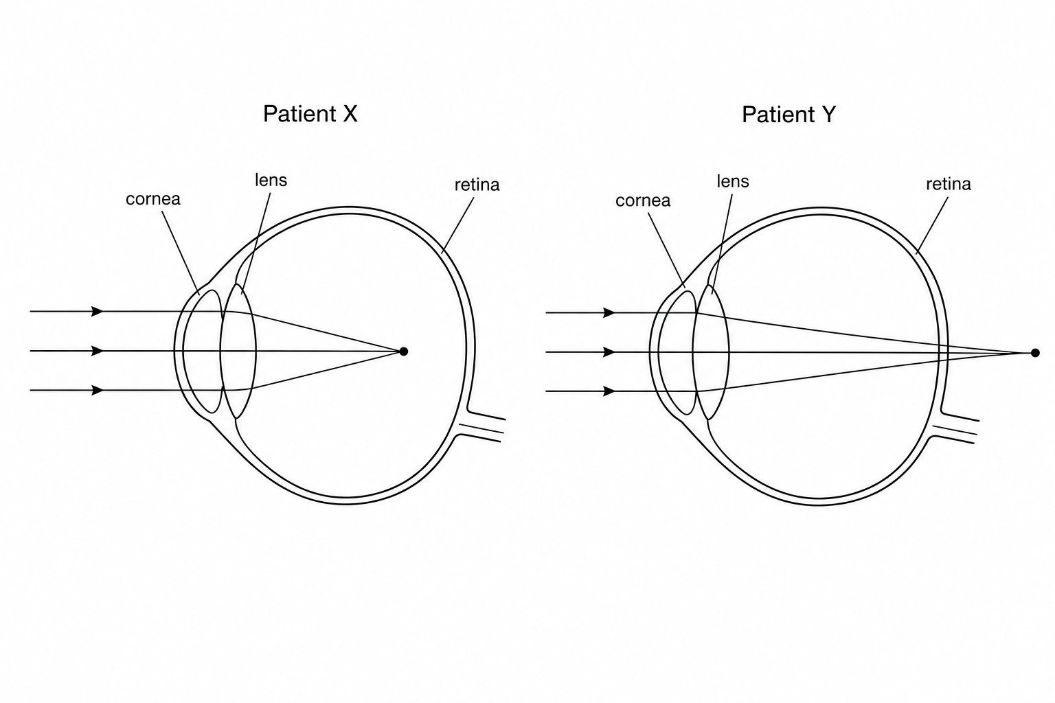 Figure 1: Ray diagrams showing light focusing in the eyes of Patient X and Patient Y.