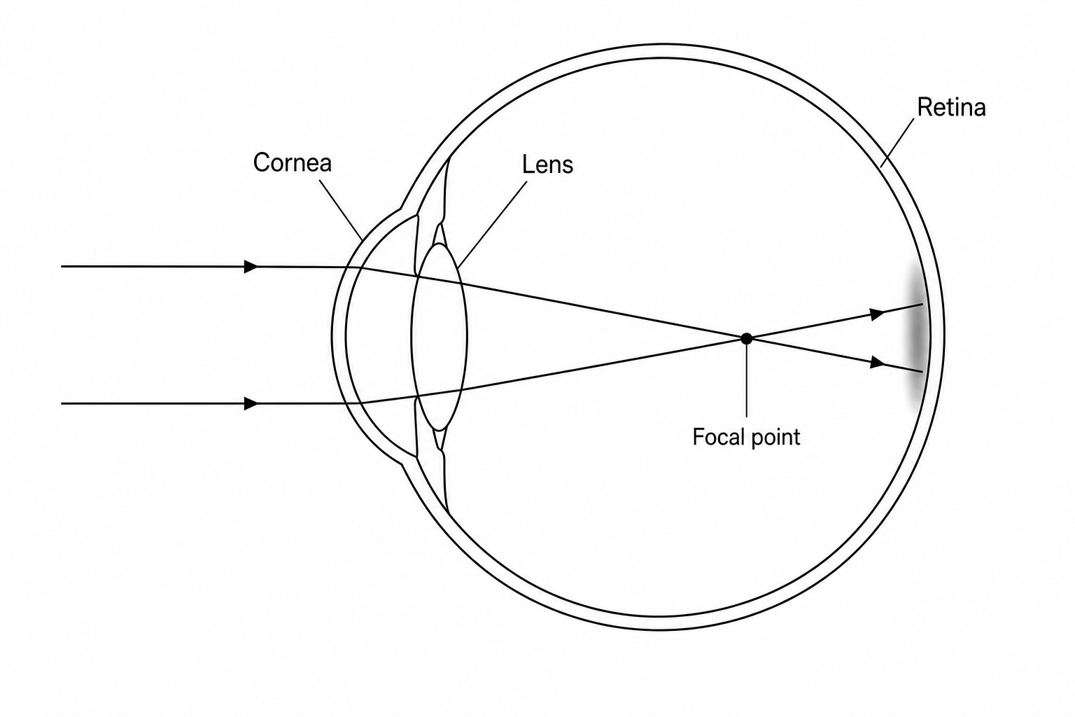Figure 1: Diagram of an eye showing myopia where parallel light rays converge in front of the retina.