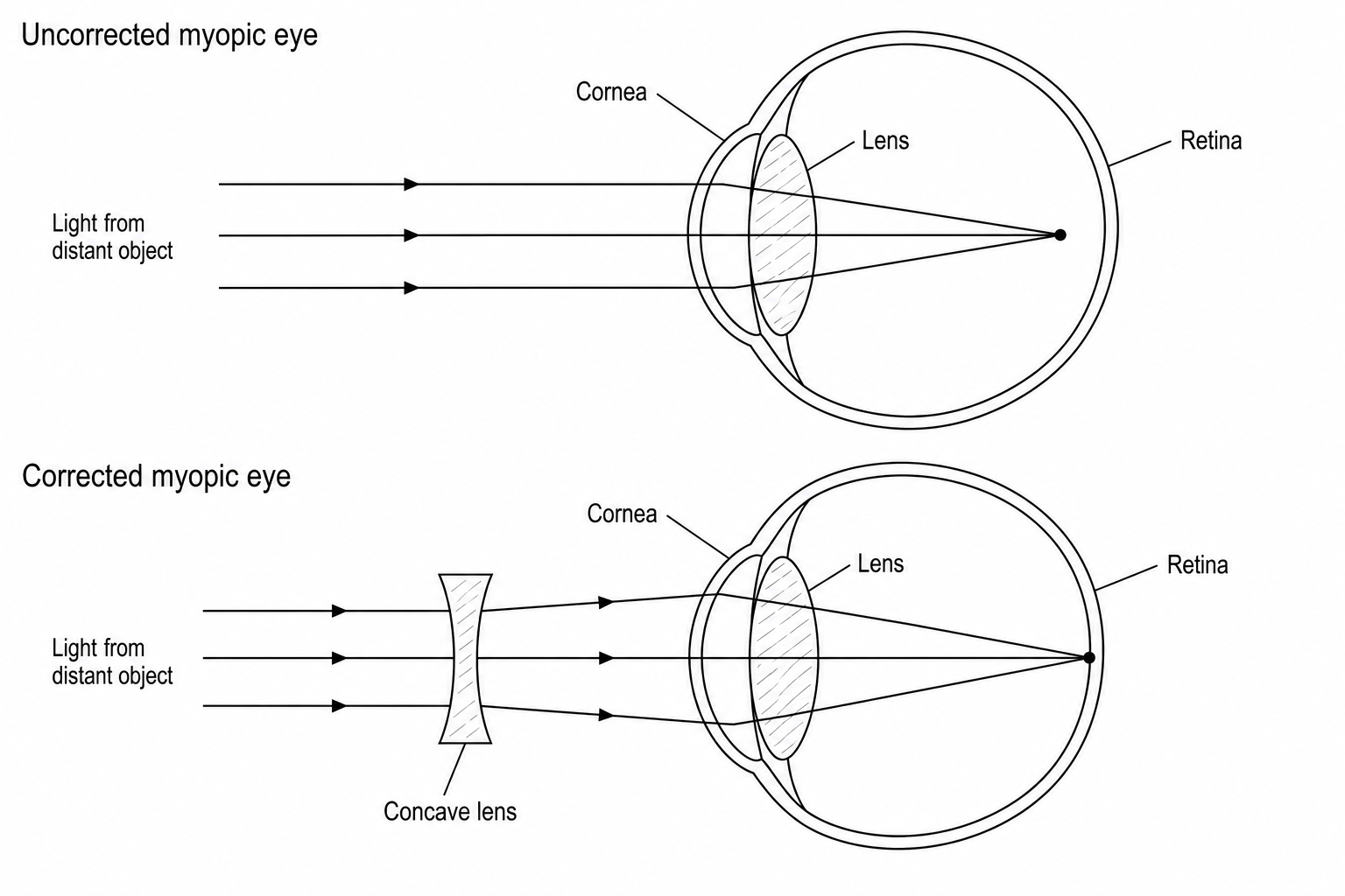 A diagram comparing an uncorrected myopic eye, where light from a distant object focuses in front of the retina, and a corrected myopic eye, where a concave lens diverges the light rays to focus them perfectly on the retina.