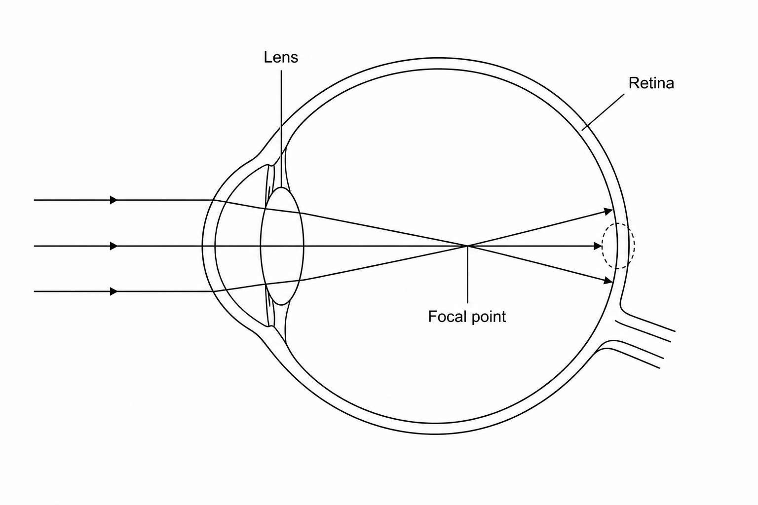 Cross-section of an eye showing short-sightedness