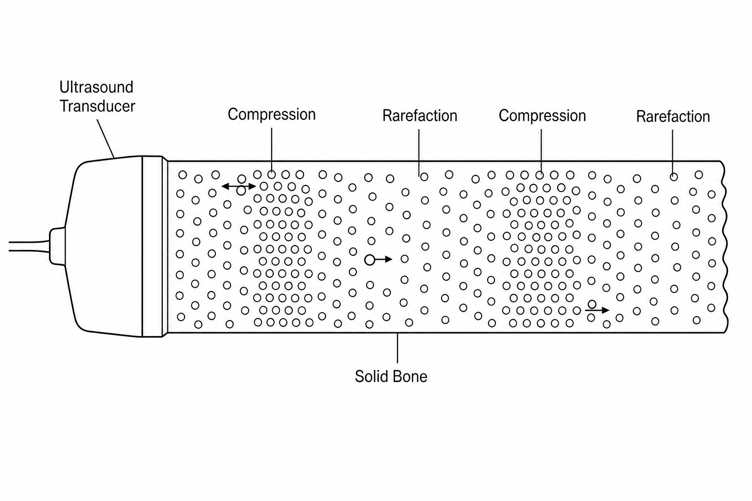 An ultrasound transducer sending waves through solid bone.