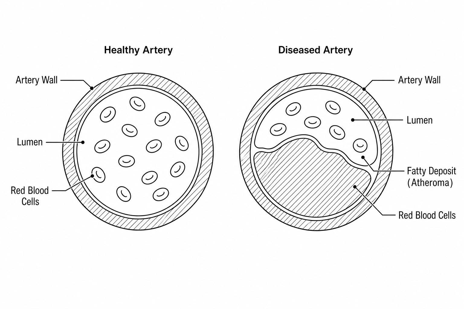 Coronary Artery Comparison