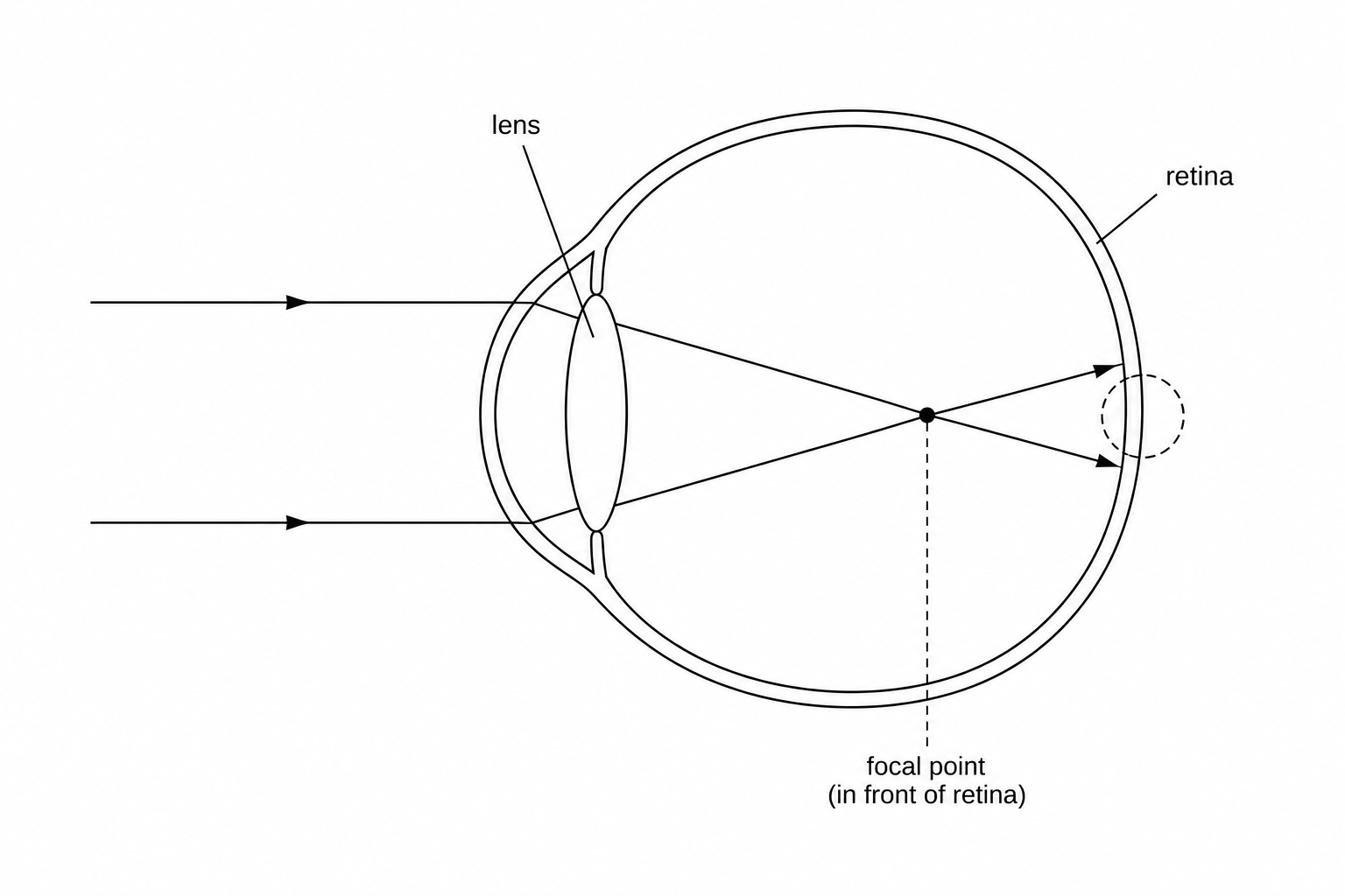 A simplified diagram of a short-sighted eye showing light rays from a distant object passing through the cornea and lens, converging to a focal point in front of the retina.