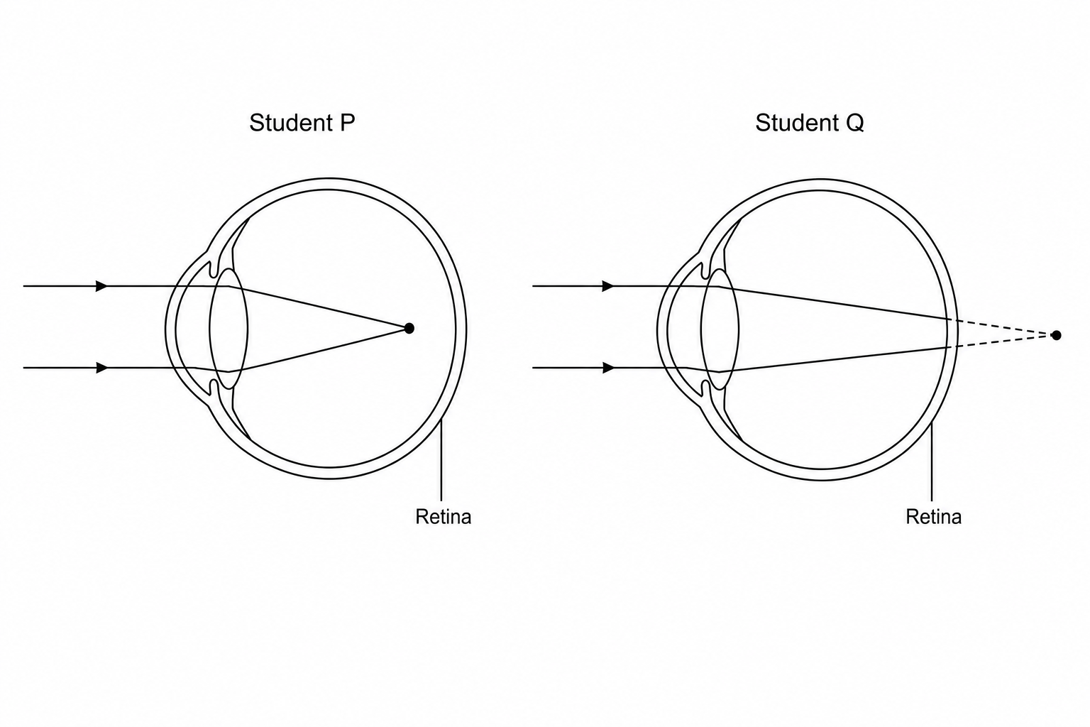 Vision defects in Student P and Student Q