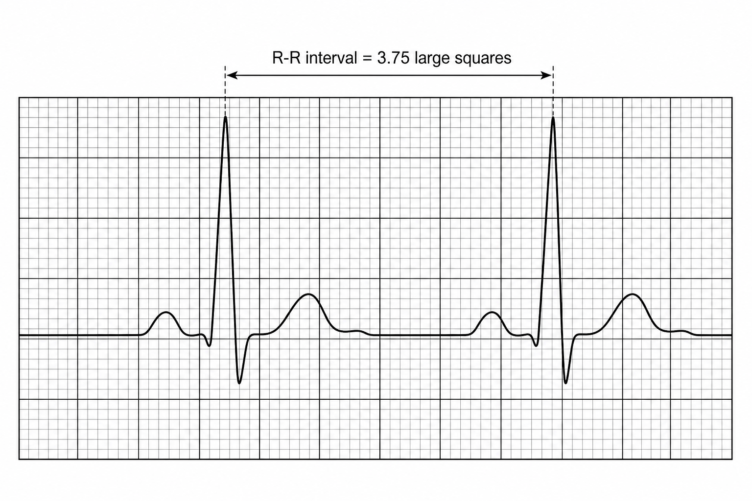 ECG Trace