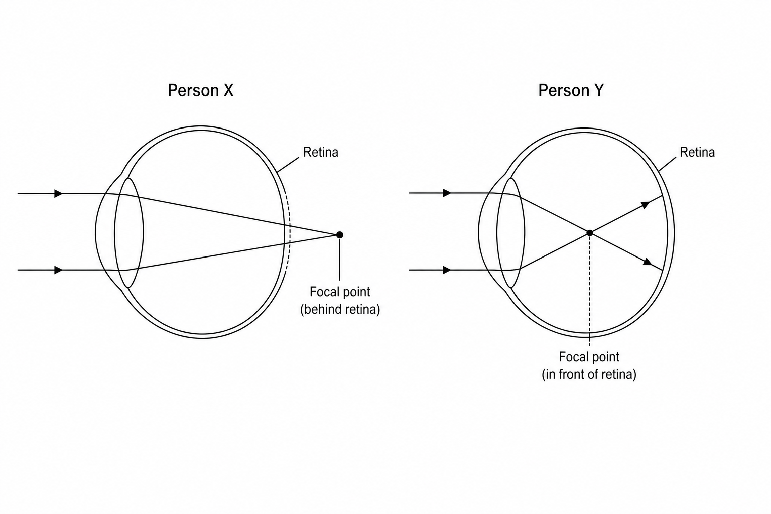 Two diagrams showing simplified horizontal cross-sections of human eyes. In the eye of Person X, the incoming light rays pass through the lens and focus at a point behind the retina. In the eye of Person Y, the incoming light rays pass through the lens and focus at a point in the middle of the eyeball, well in front of the retina.
