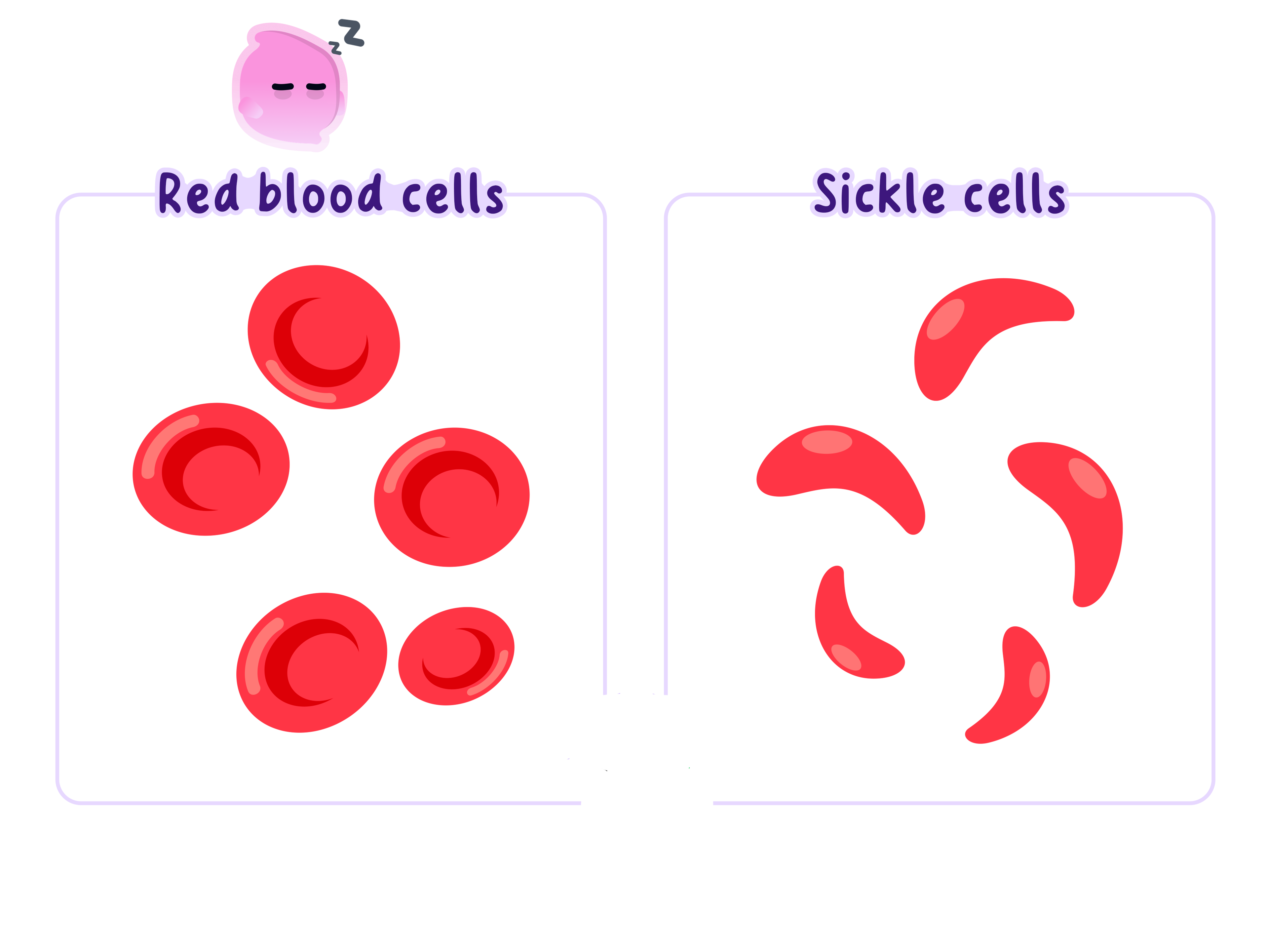 A comparison of normal red blood cells and sickle cells, illustrating how a genetic variant in coding DNA can change a protein and result in an altered characteristic.