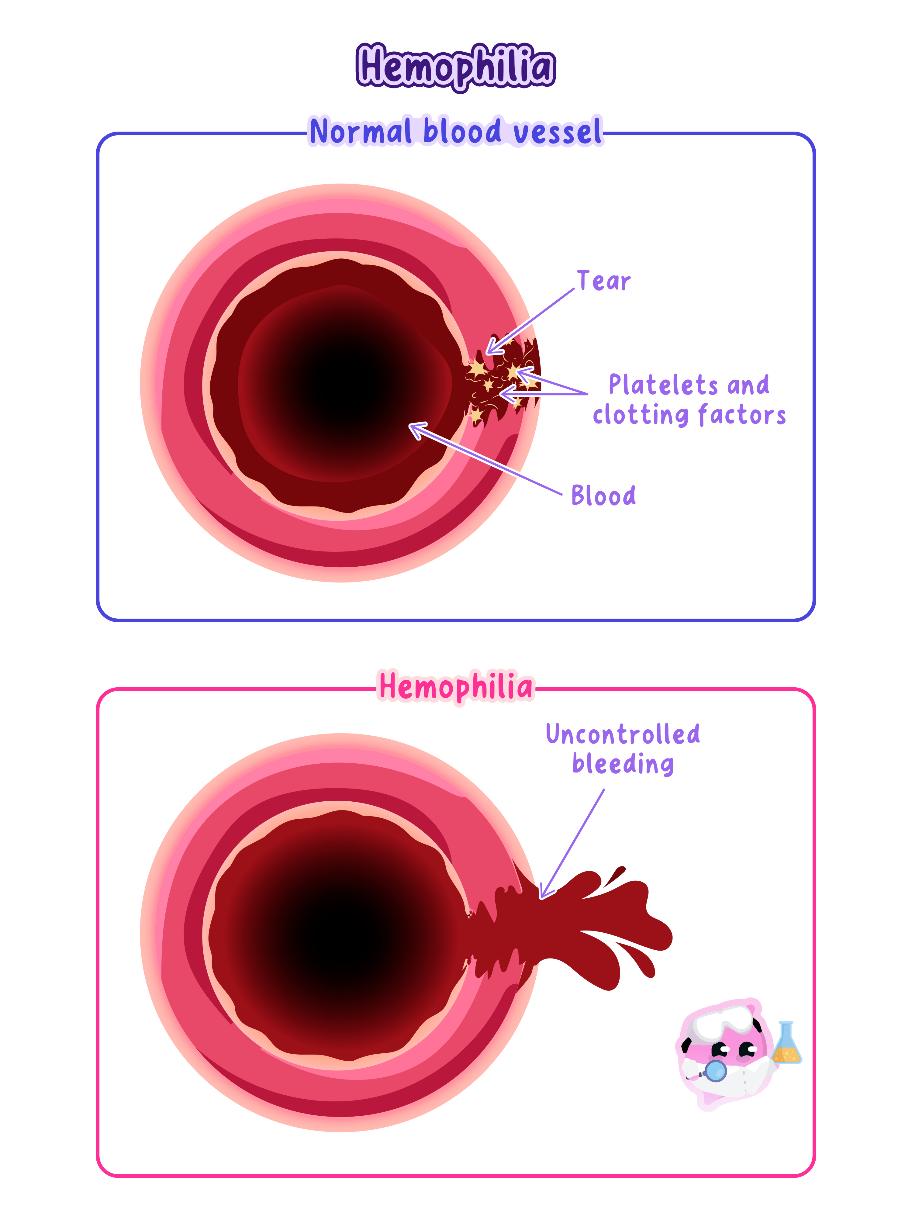 A diagram comparing a normal blood vessel and one with haemophilia. In the normal vessel, a tear is repaired by platelets and clotting factors, preventing blood loss. In the vessel with haemophilia, the lack of clotting factors results in uncontrolled bleeding from the tear.