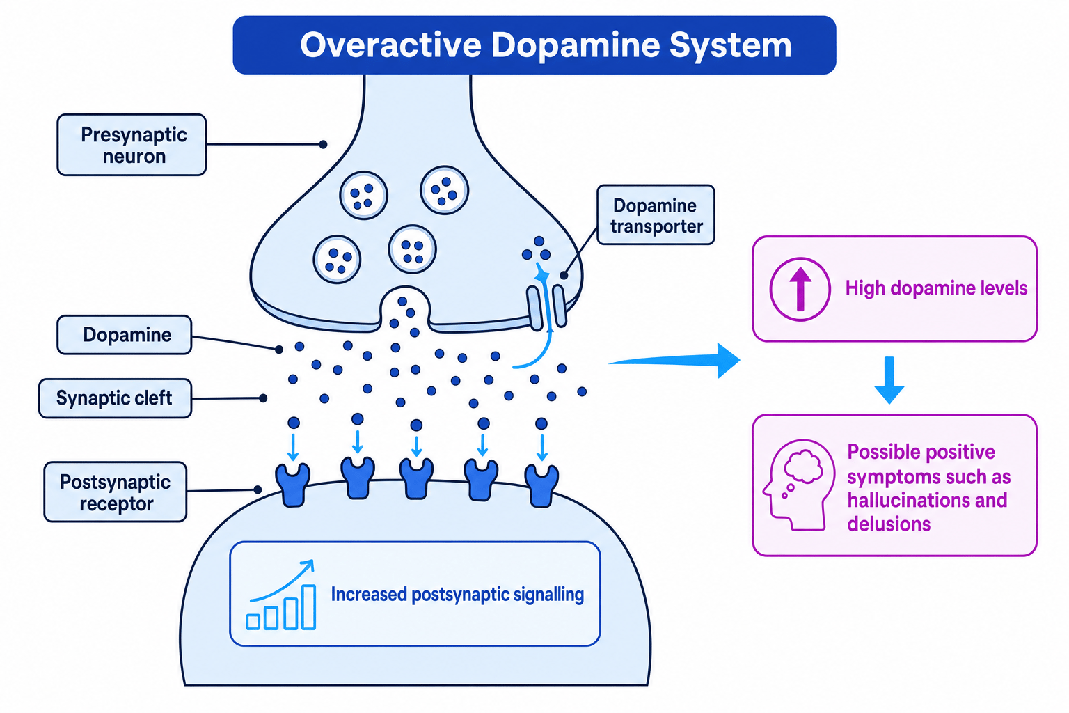 Labelled schematic of an overactive dopamine synapse in schizophrenia